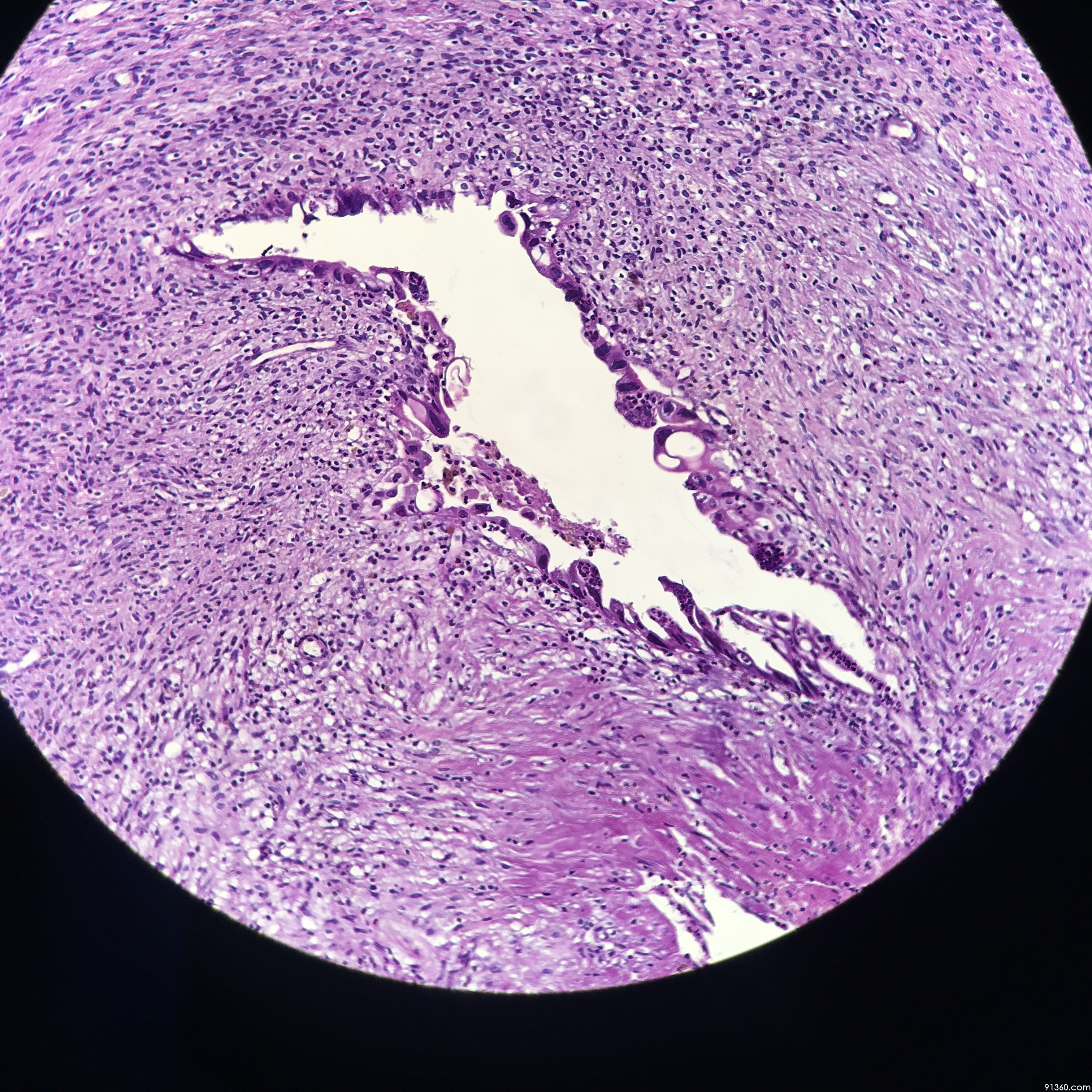 子宫内膜异位?【中美加卵巢肿瘤病理交流群294】