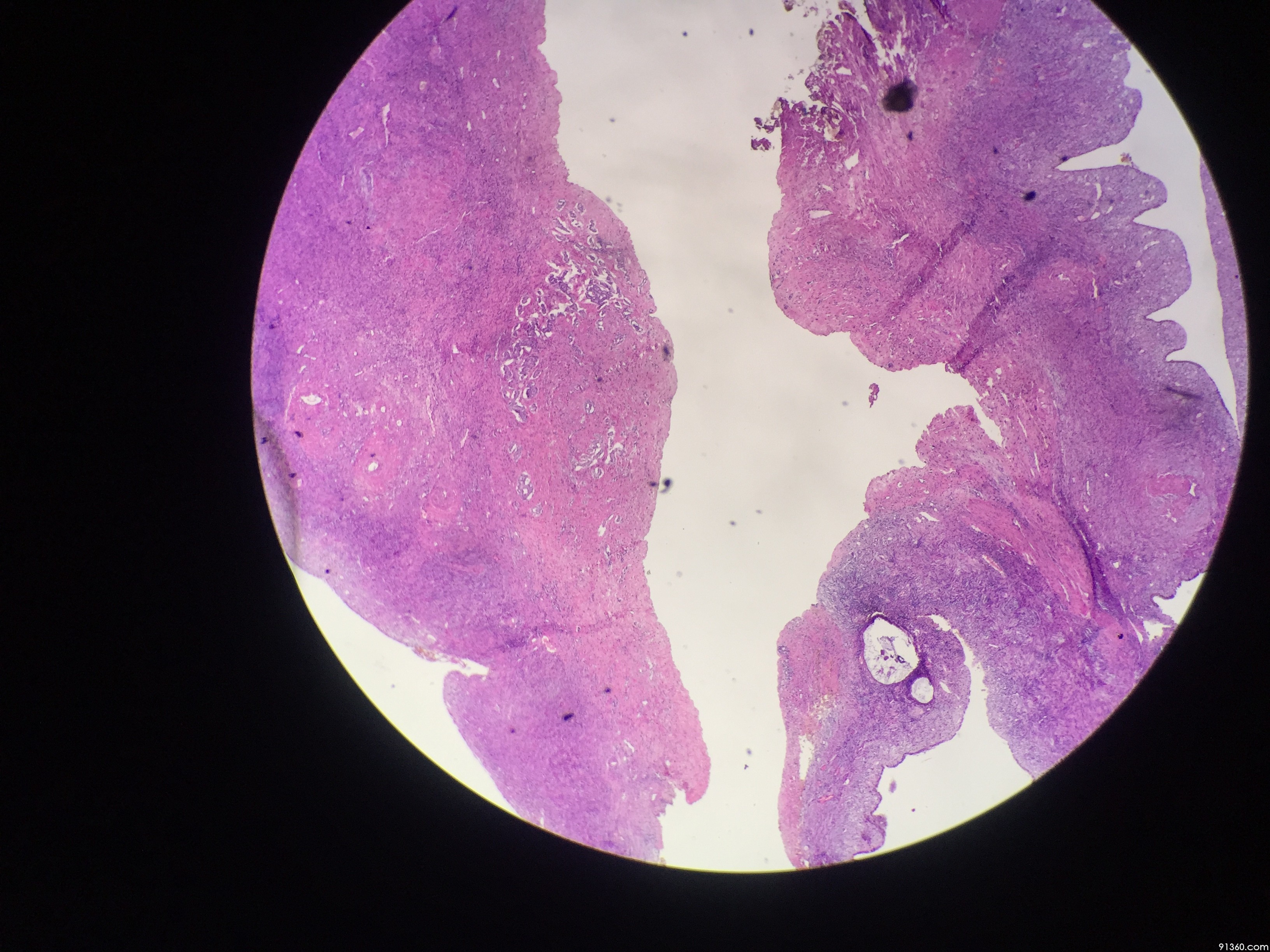 间皮细胞反应性增生中美加卵巢肿瘤病理交流群300