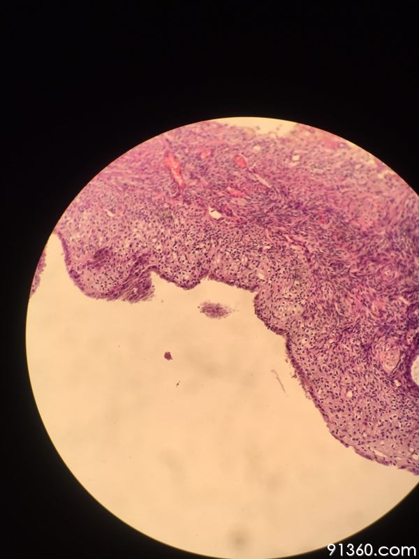 间皮细胞反应性增生中美加卵巢肿瘤病理交流群300