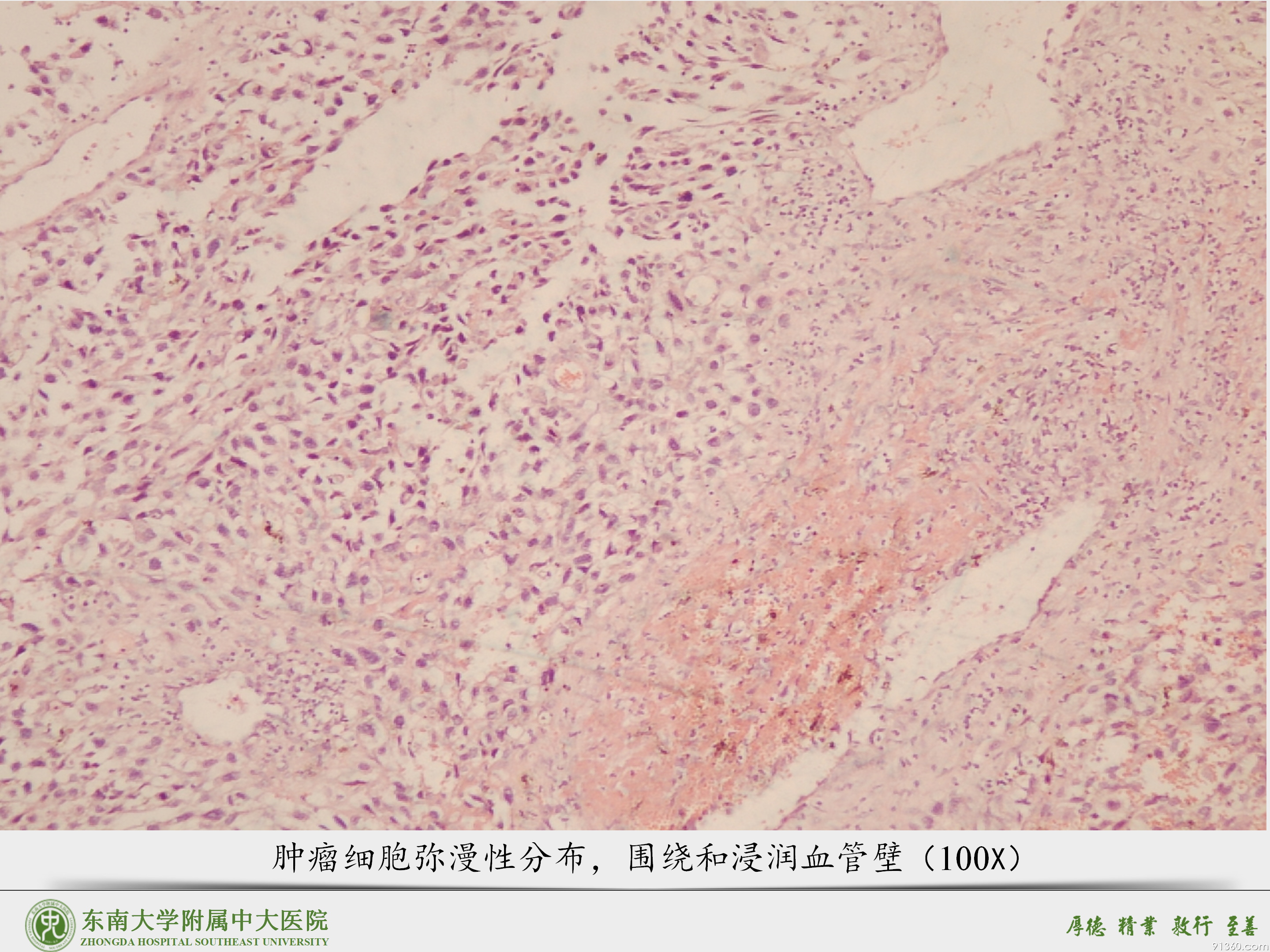 中大病例推送  胎盘部位滋养细胞肿瘤_04.png