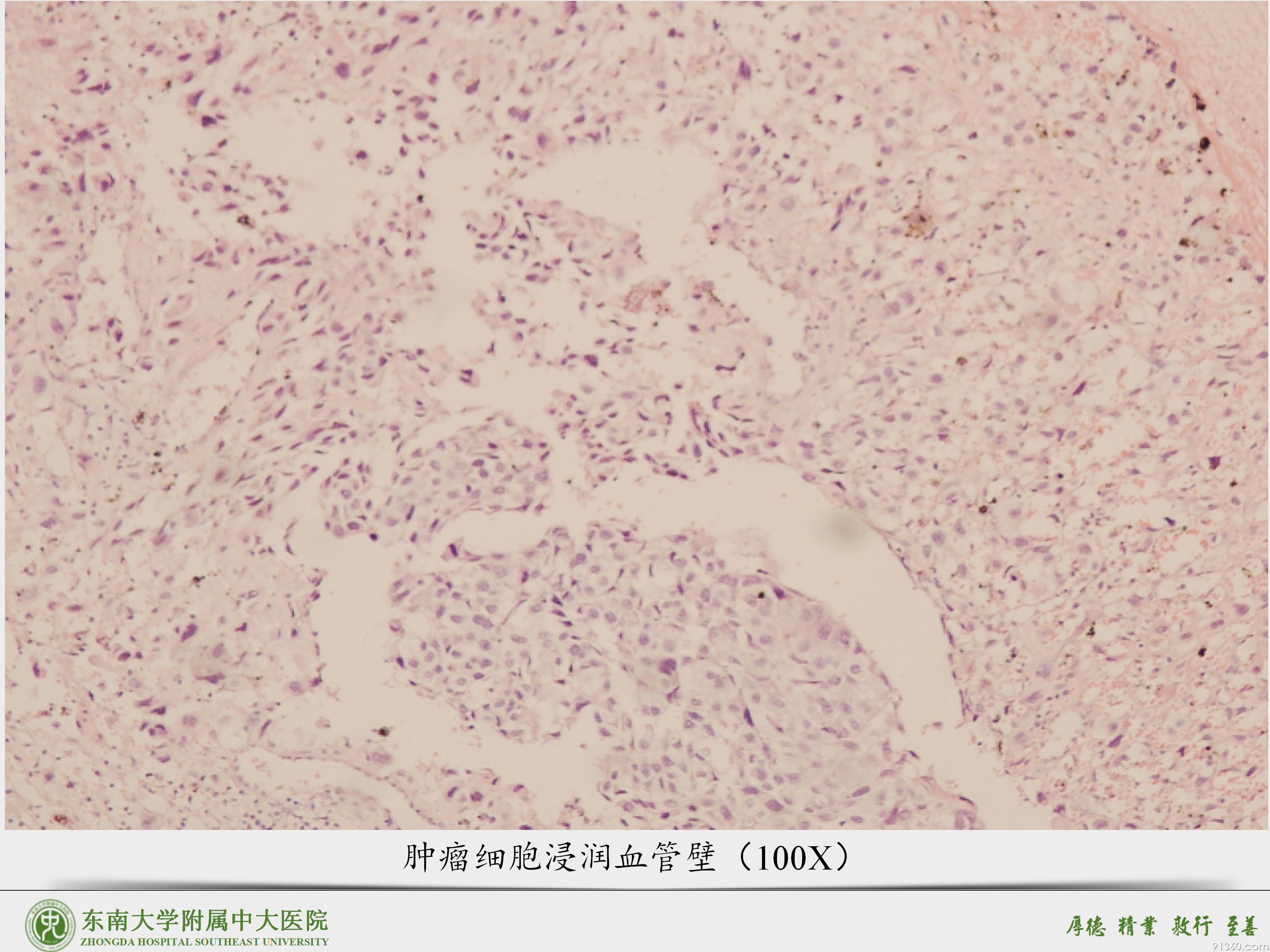 中大病例推送  胎盘部位滋养细胞肿瘤_05.png