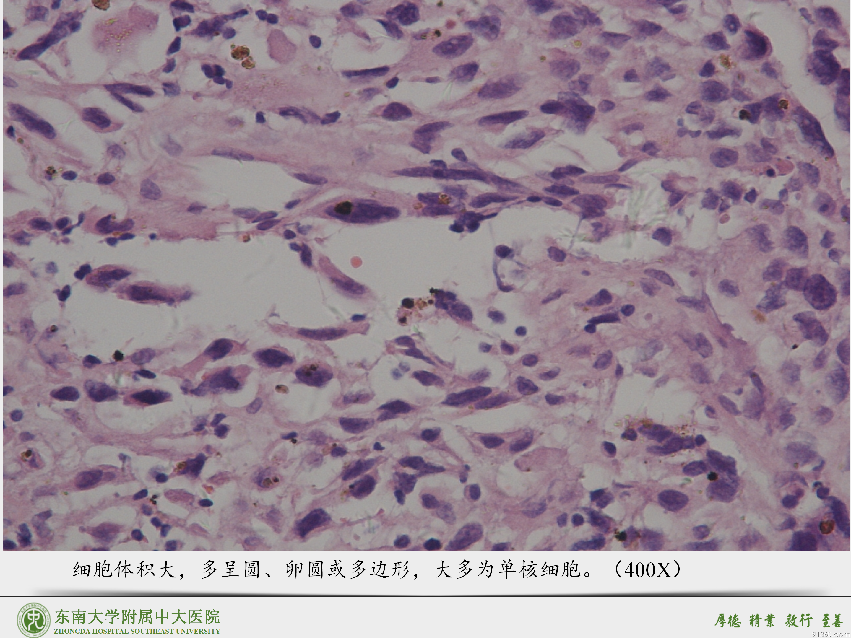 中大病例推送  胎盘部位滋养细胞肿瘤_07.png