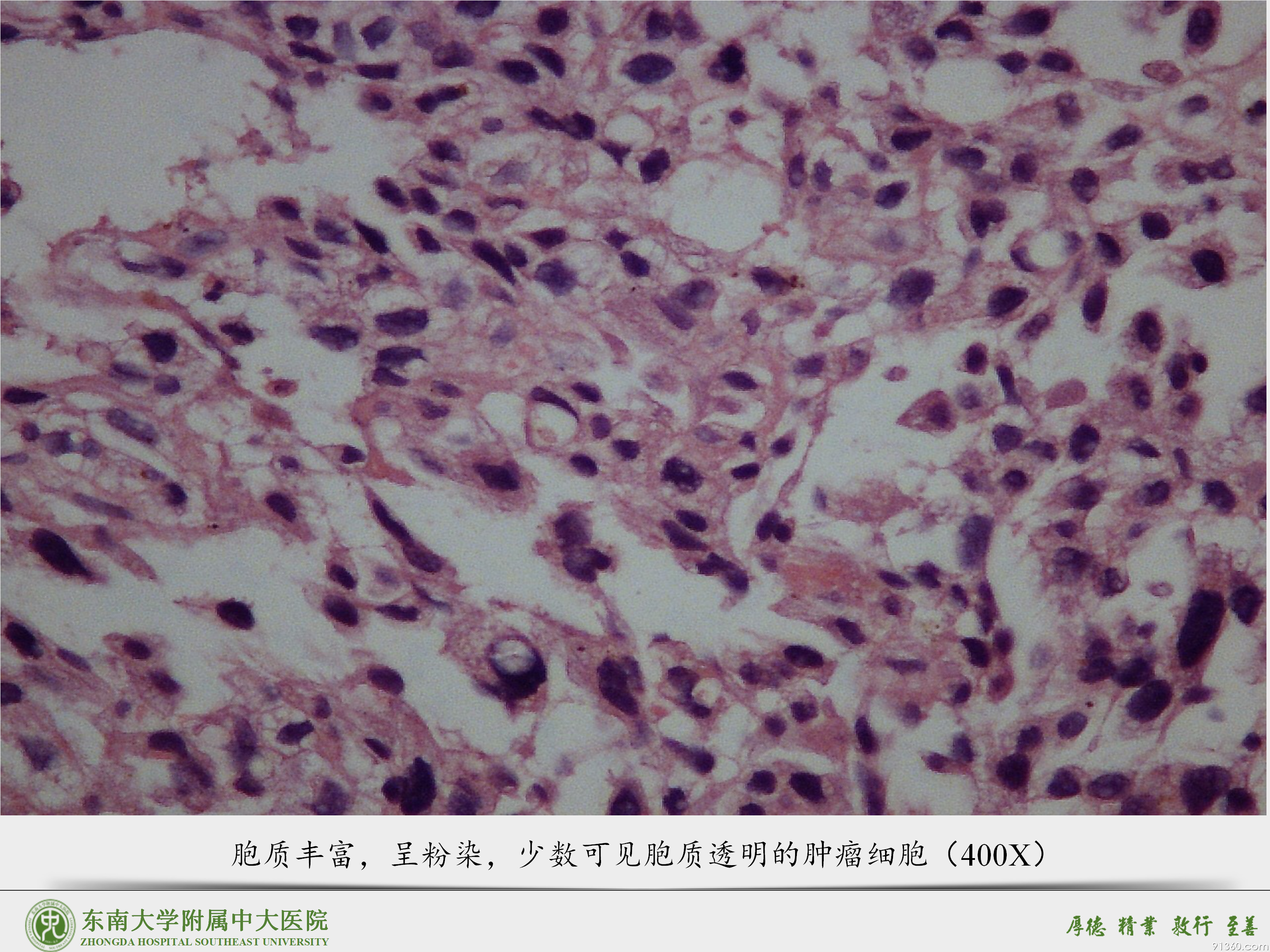中大病例推送  胎盘部位滋养细胞肿瘤_09.png