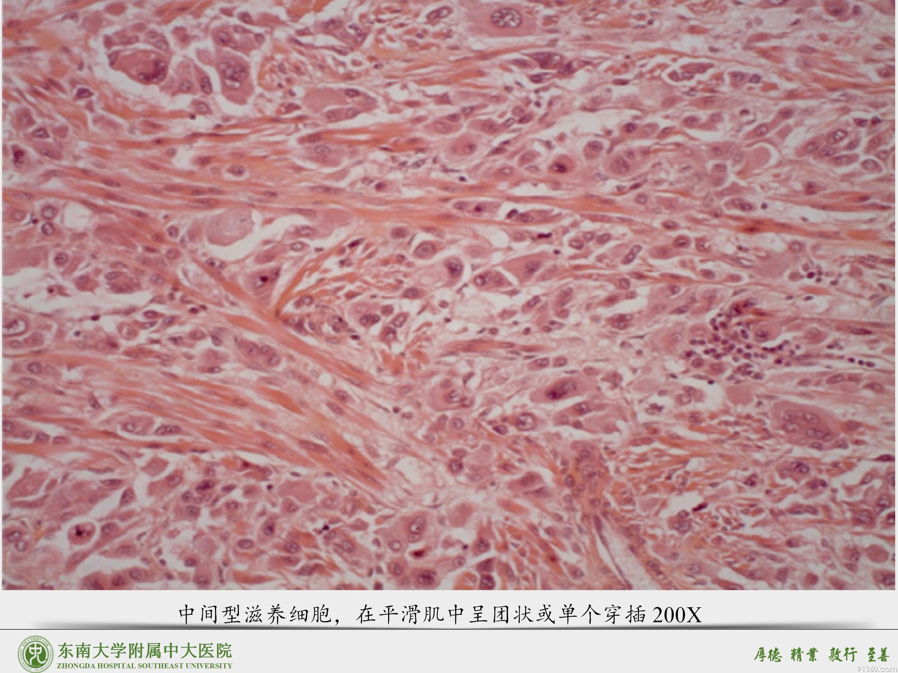 中大病例推送  胎盘部位滋养细胞肿瘤_34.jpg