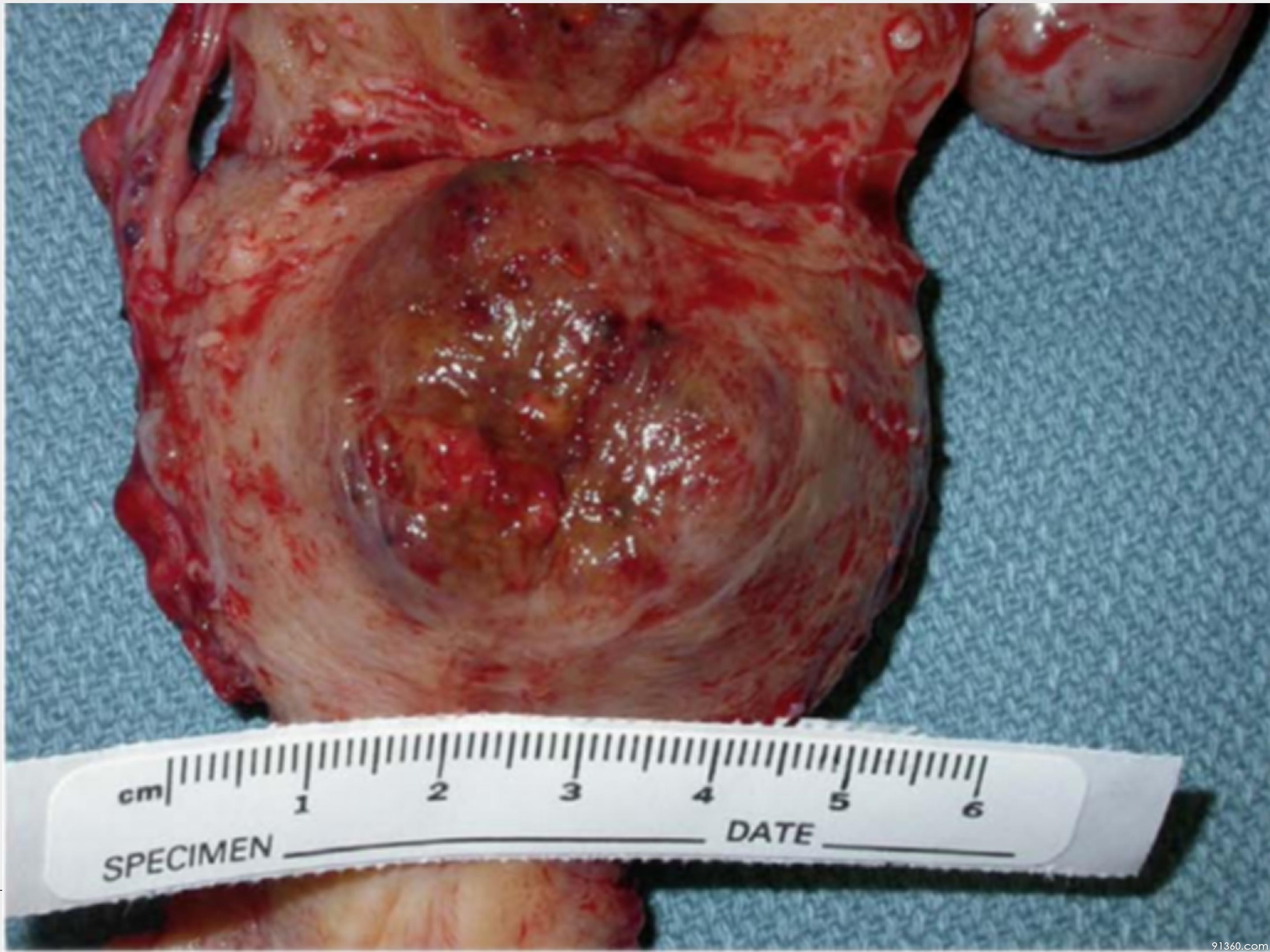 中大病例推送  胎盘部位滋养细胞肿瘤_32.jpg