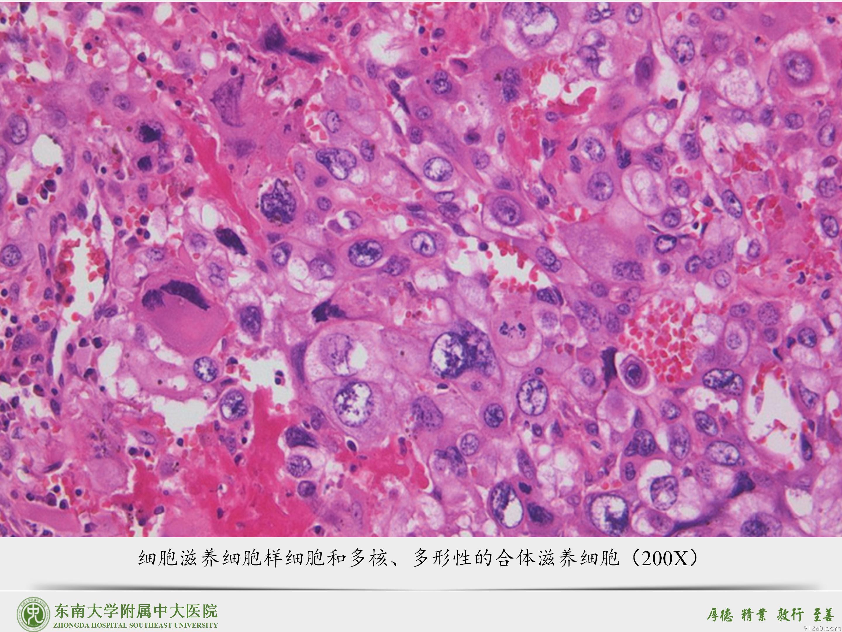 中大病例推送  胎盘部位滋养细胞肿瘤_42.jpg