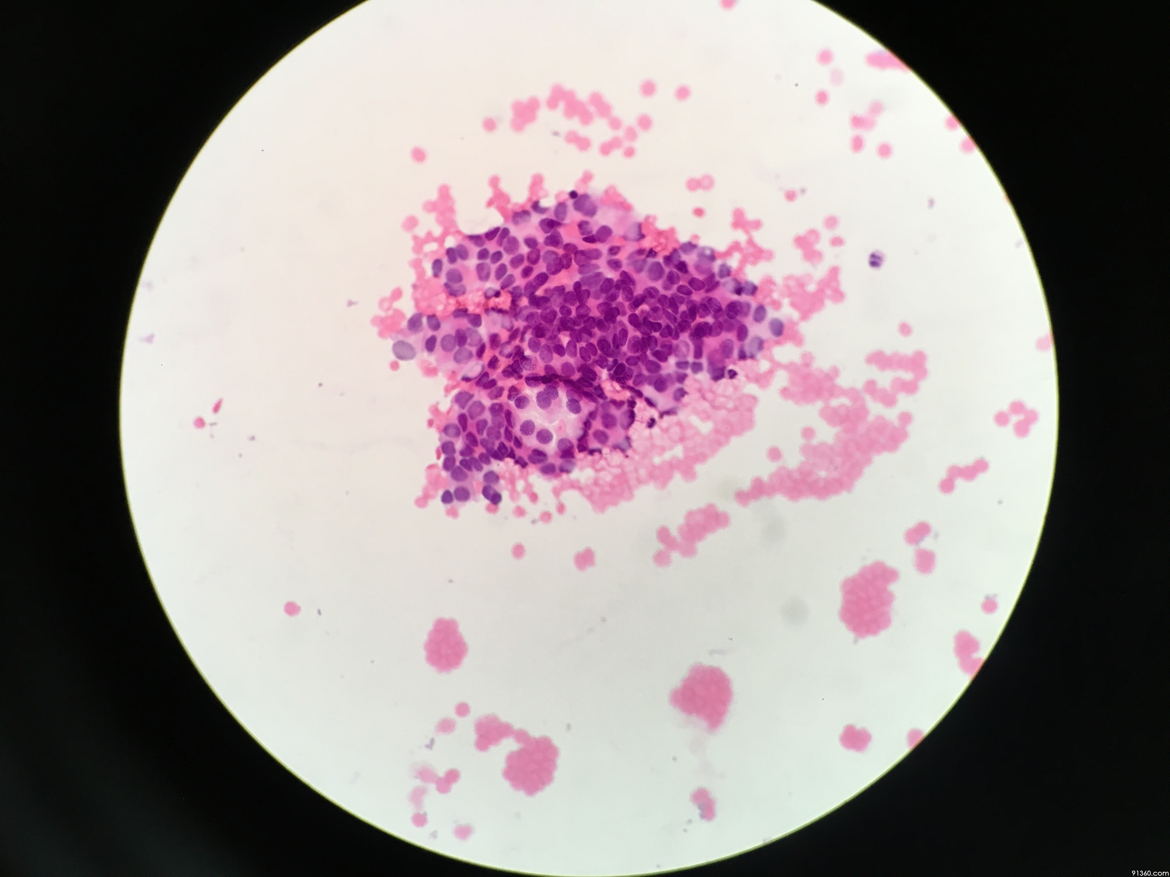 甲状腺穿刺涂片 - 细胞病理 - 91360病理论坛