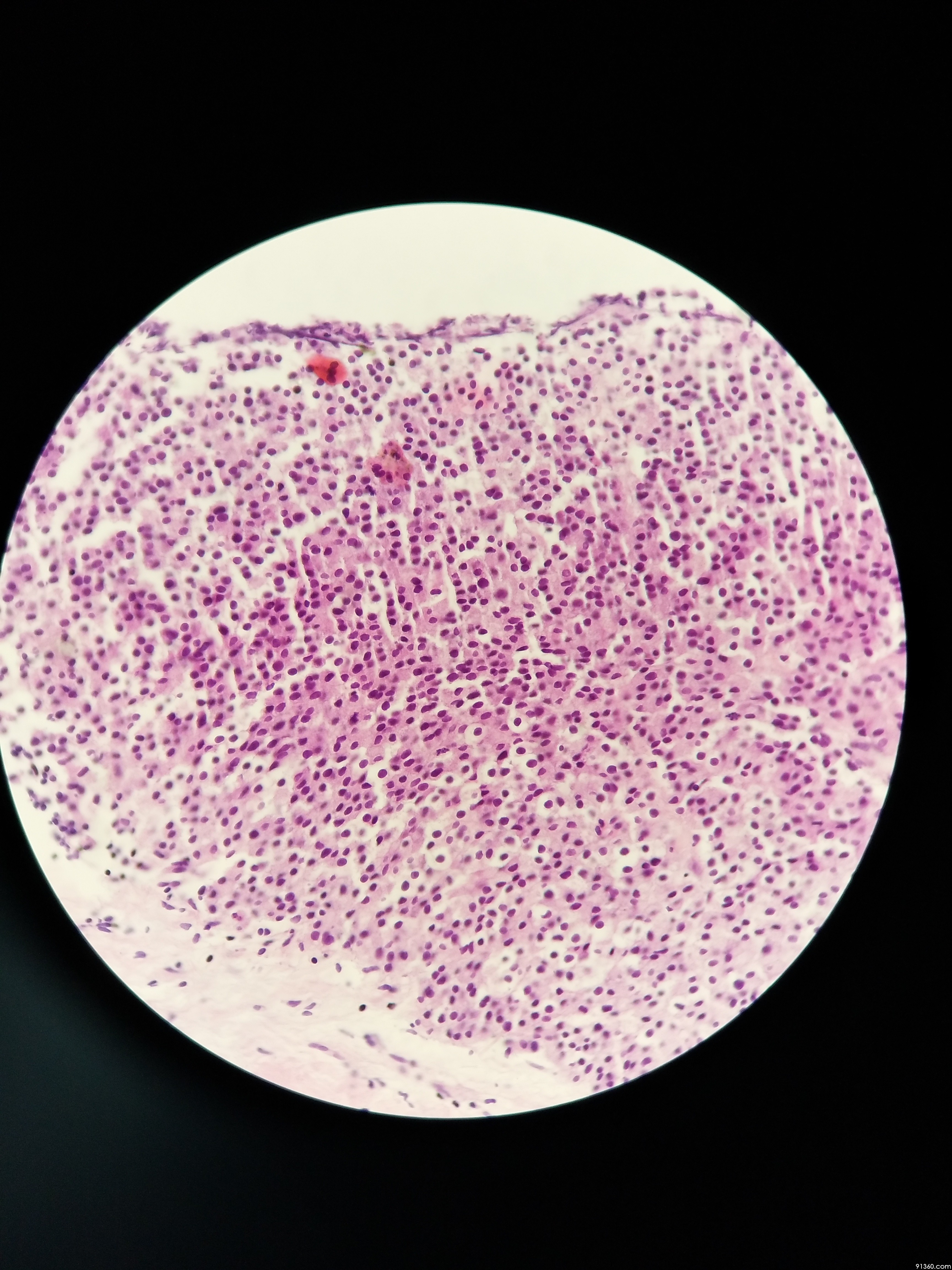 肉芽组织炎细胞图片