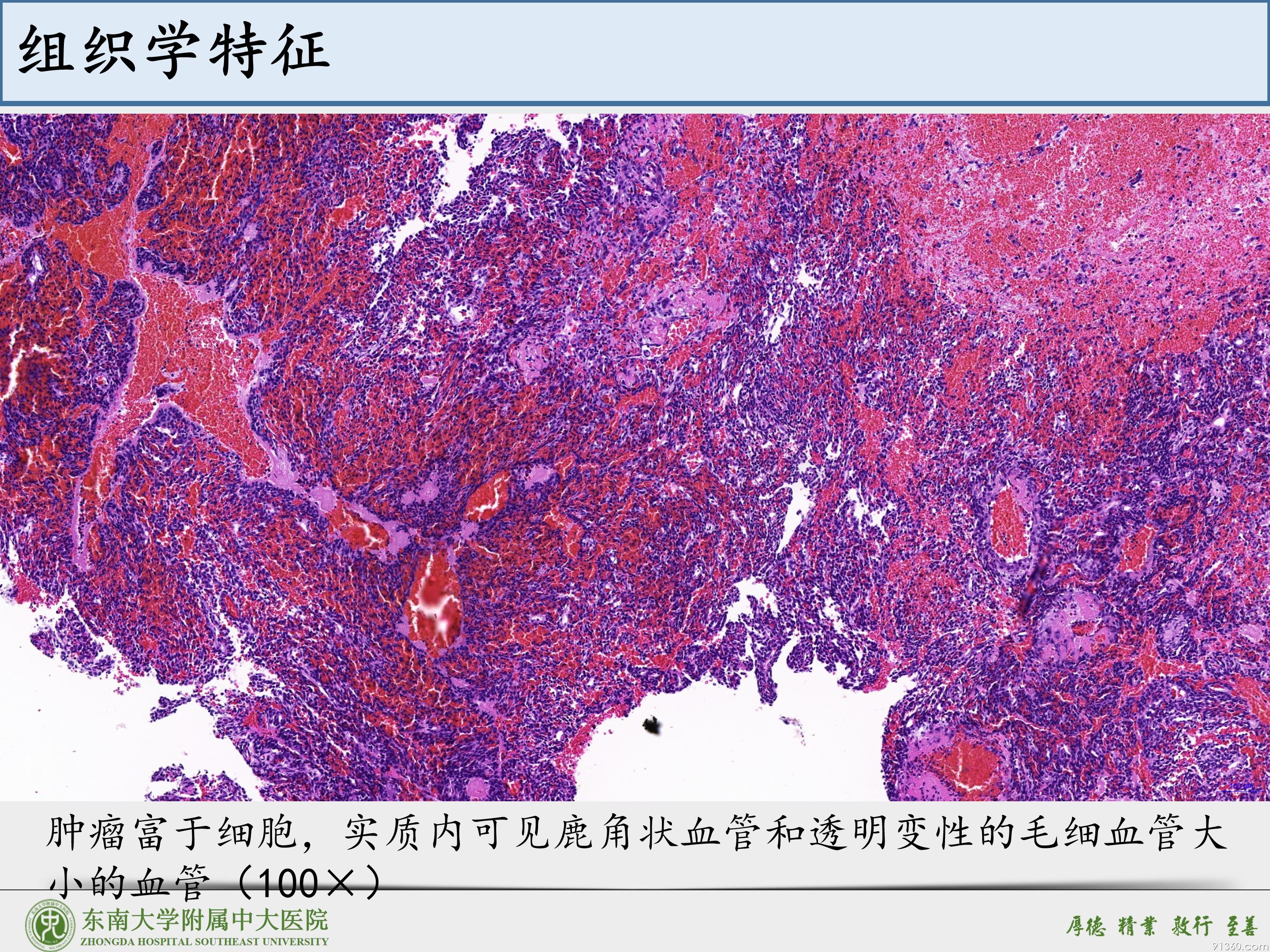 鼻腔鼻窦球血管外皮细胞瘤_10.jpg