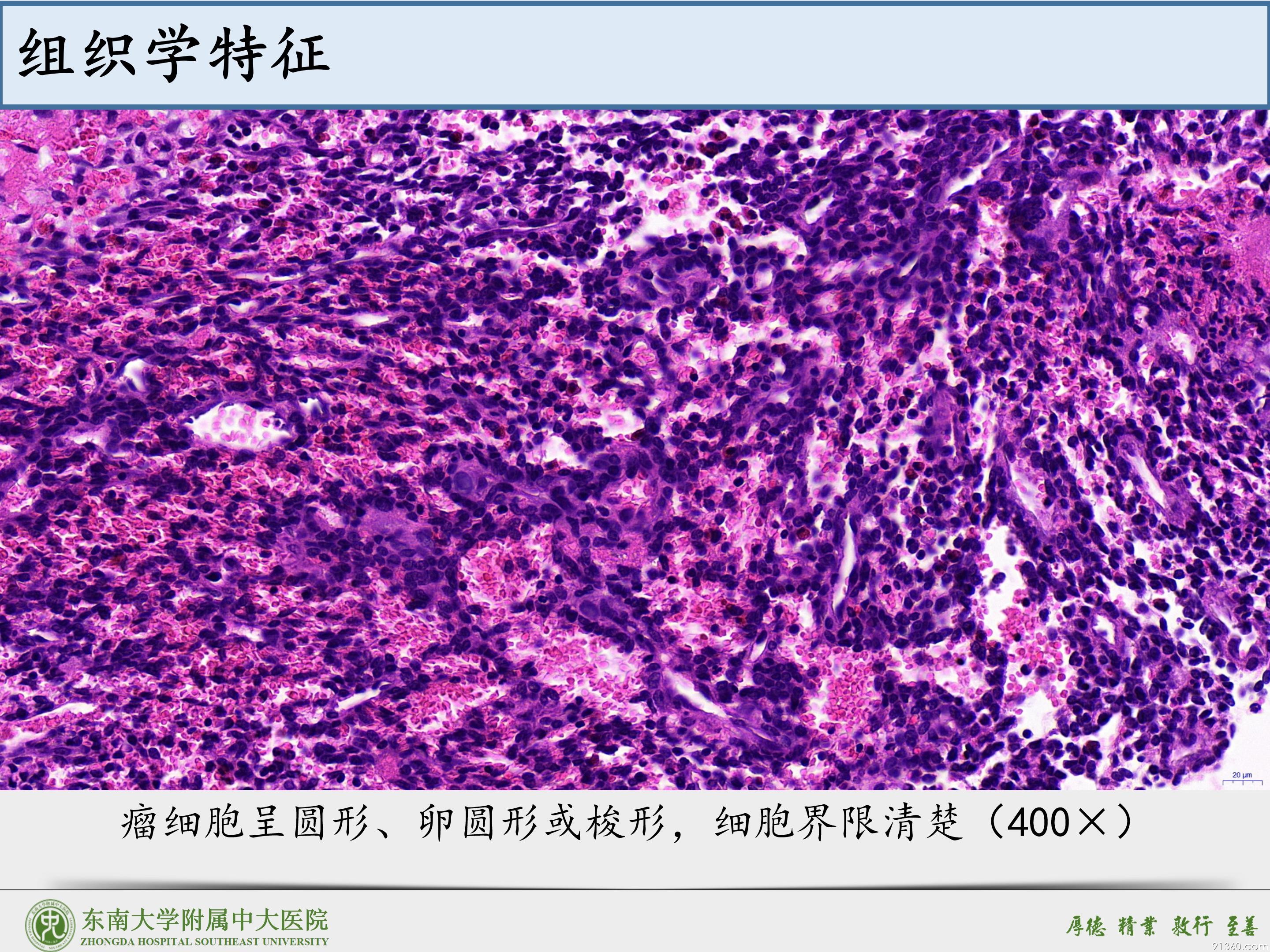 鼻腔鼻窦球血管外皮细胞瘤_12.jpg
