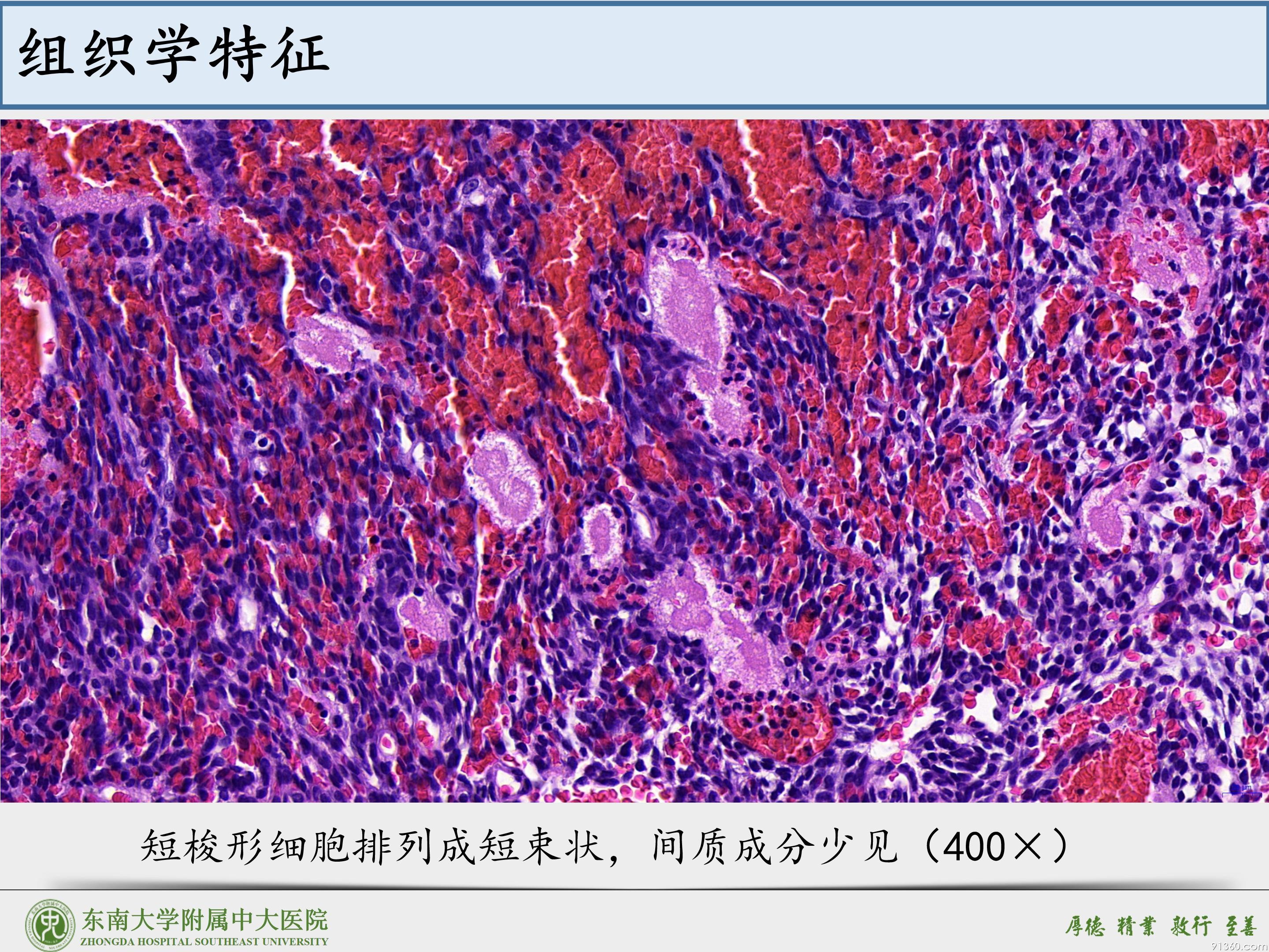 鼻腔鼻窦球血管外皮细胞瘤_13.jpg