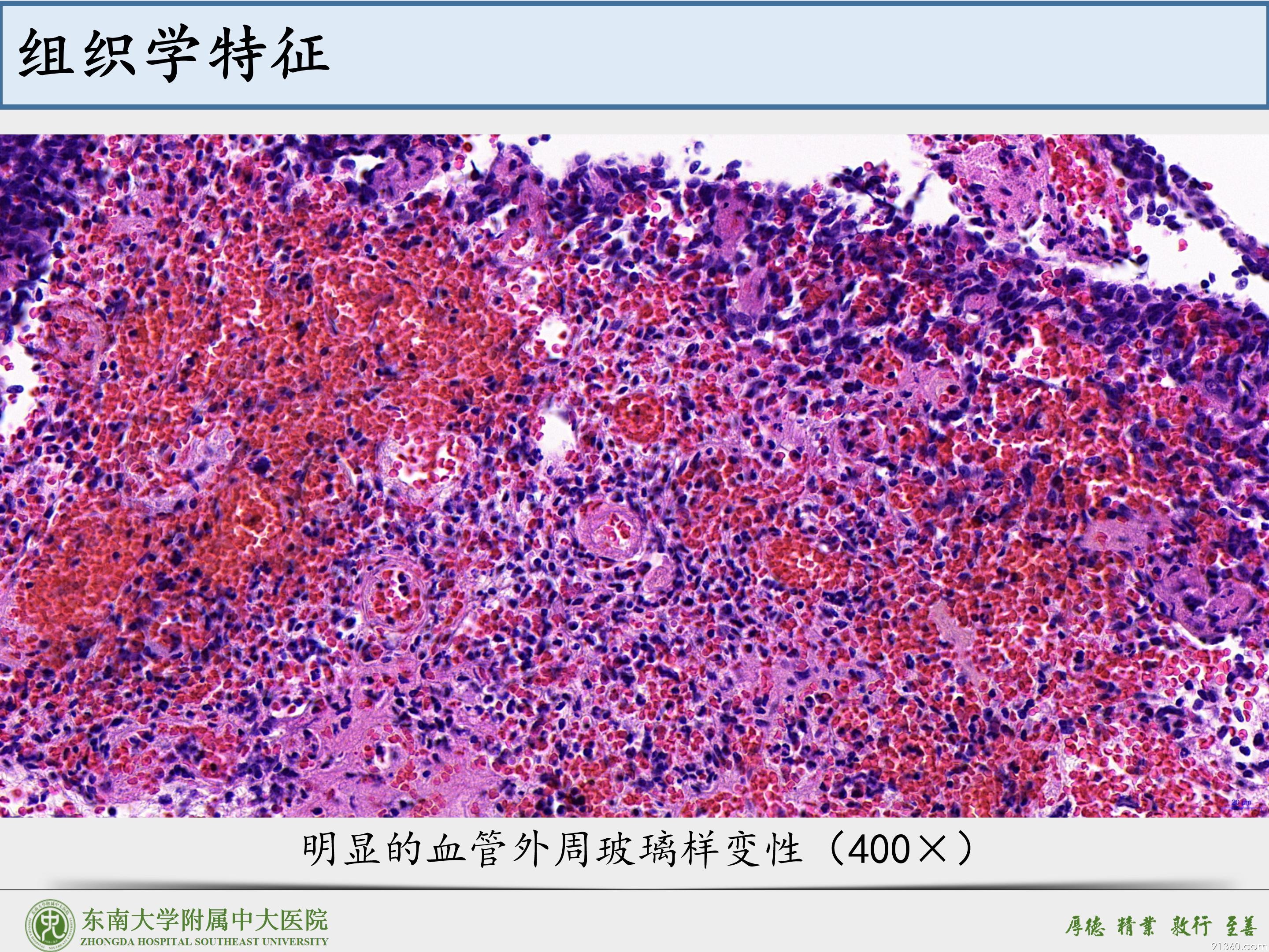 鼻腔鼻窦球血管外皮细胞瘤_14.jpg
