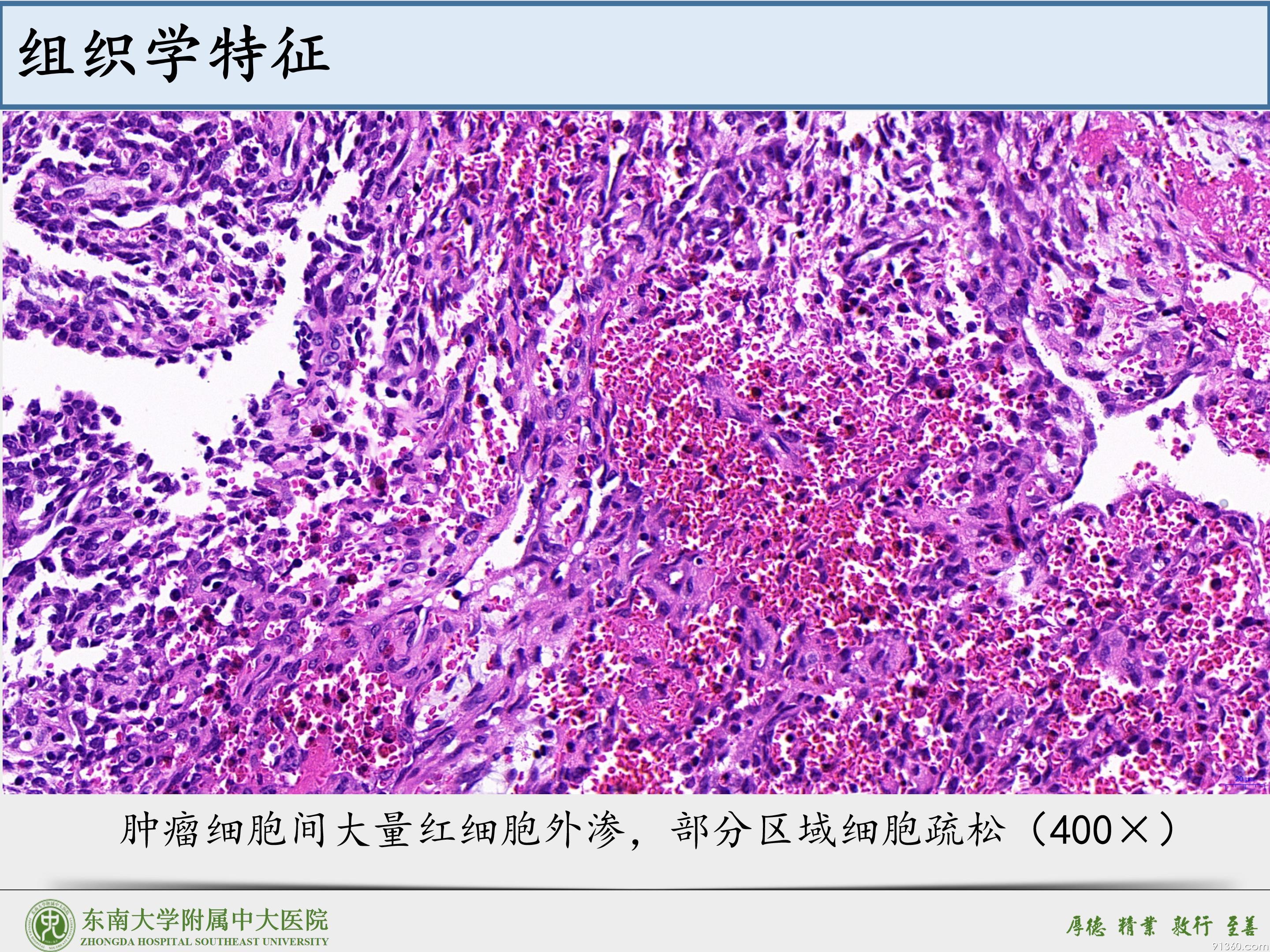 鼻腔鼻窦球血管外皮细胞瘤_15.jpg