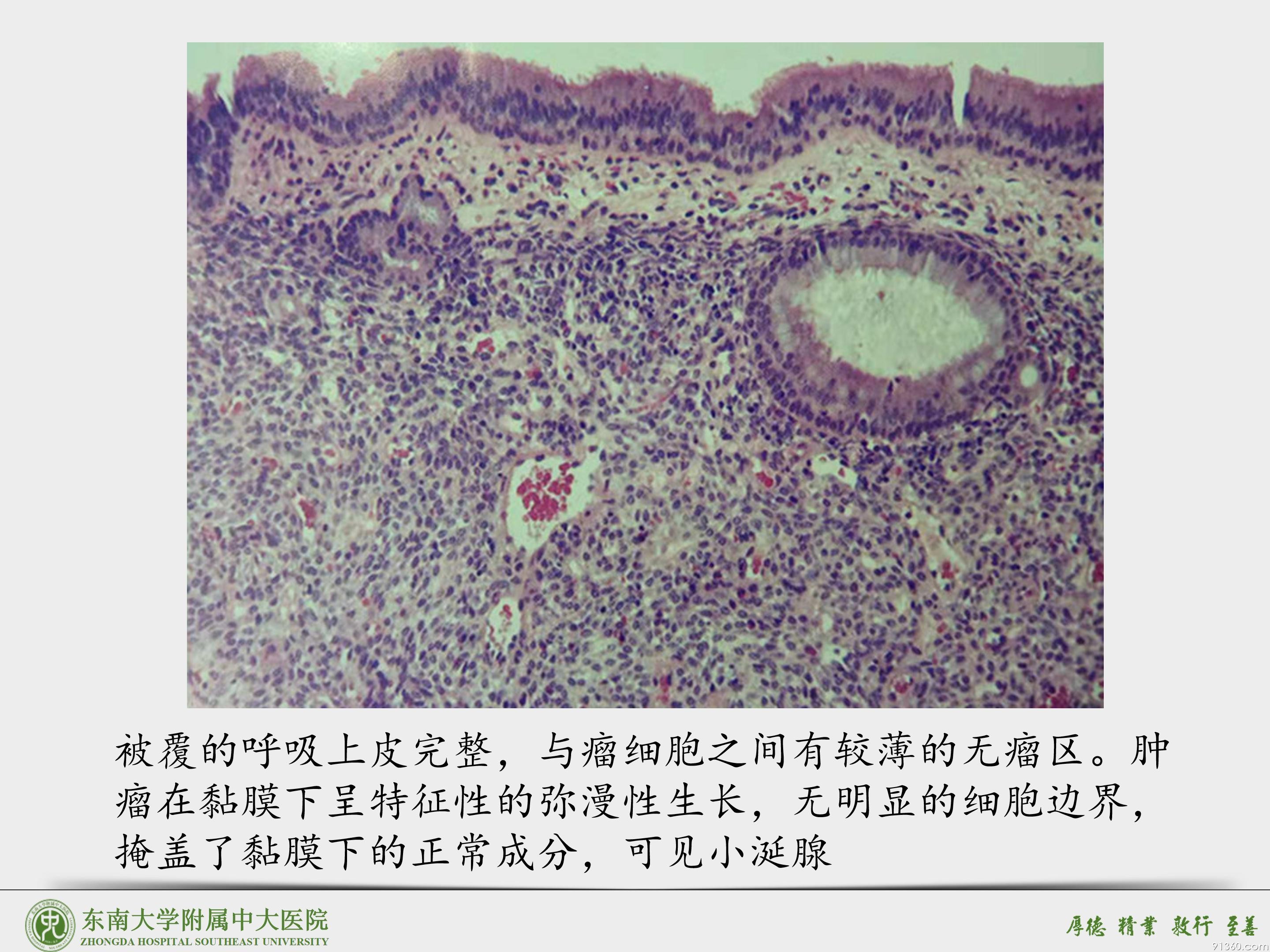 鼻腔鼻窦球血管外皮细胞瘤_39.jpg
