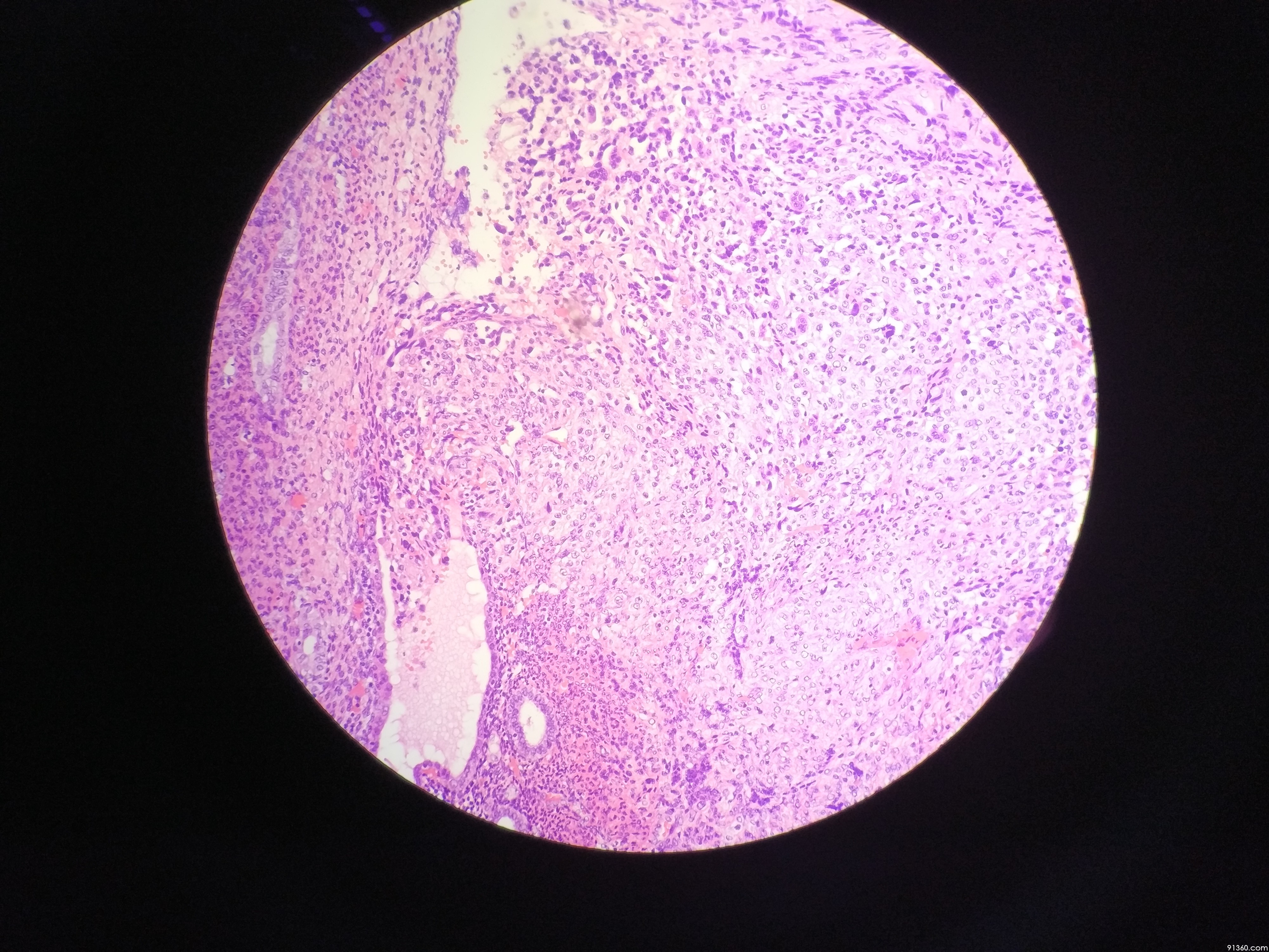 平滑肌肉瘤?讨论病例【中美加子宫内膜病理交流群449】