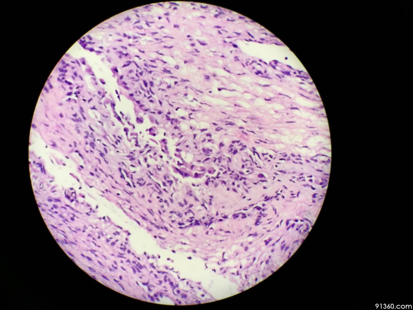 子宫内膜异位症【中美加卵巢肿瘤病理交流群319】