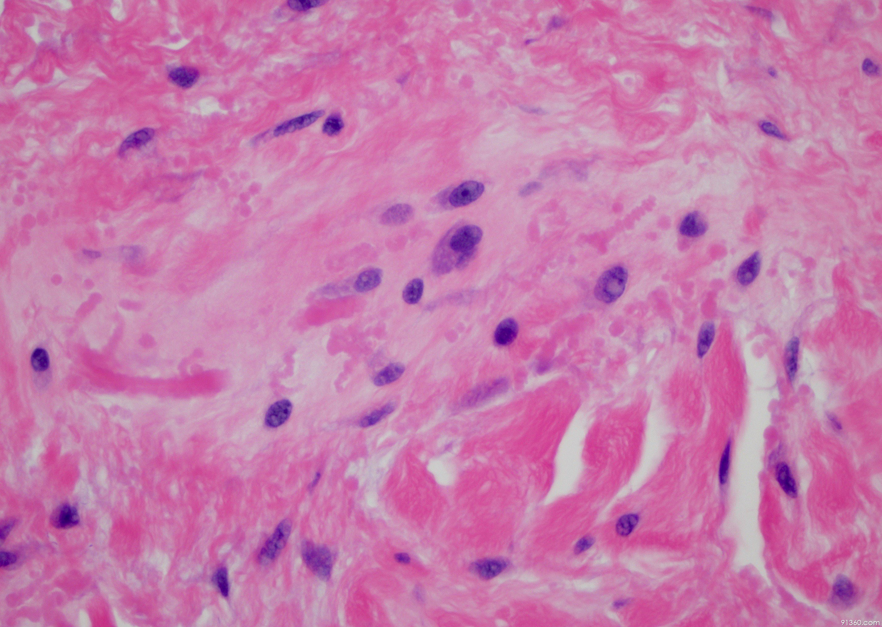 纤维板层型肝细胞癌