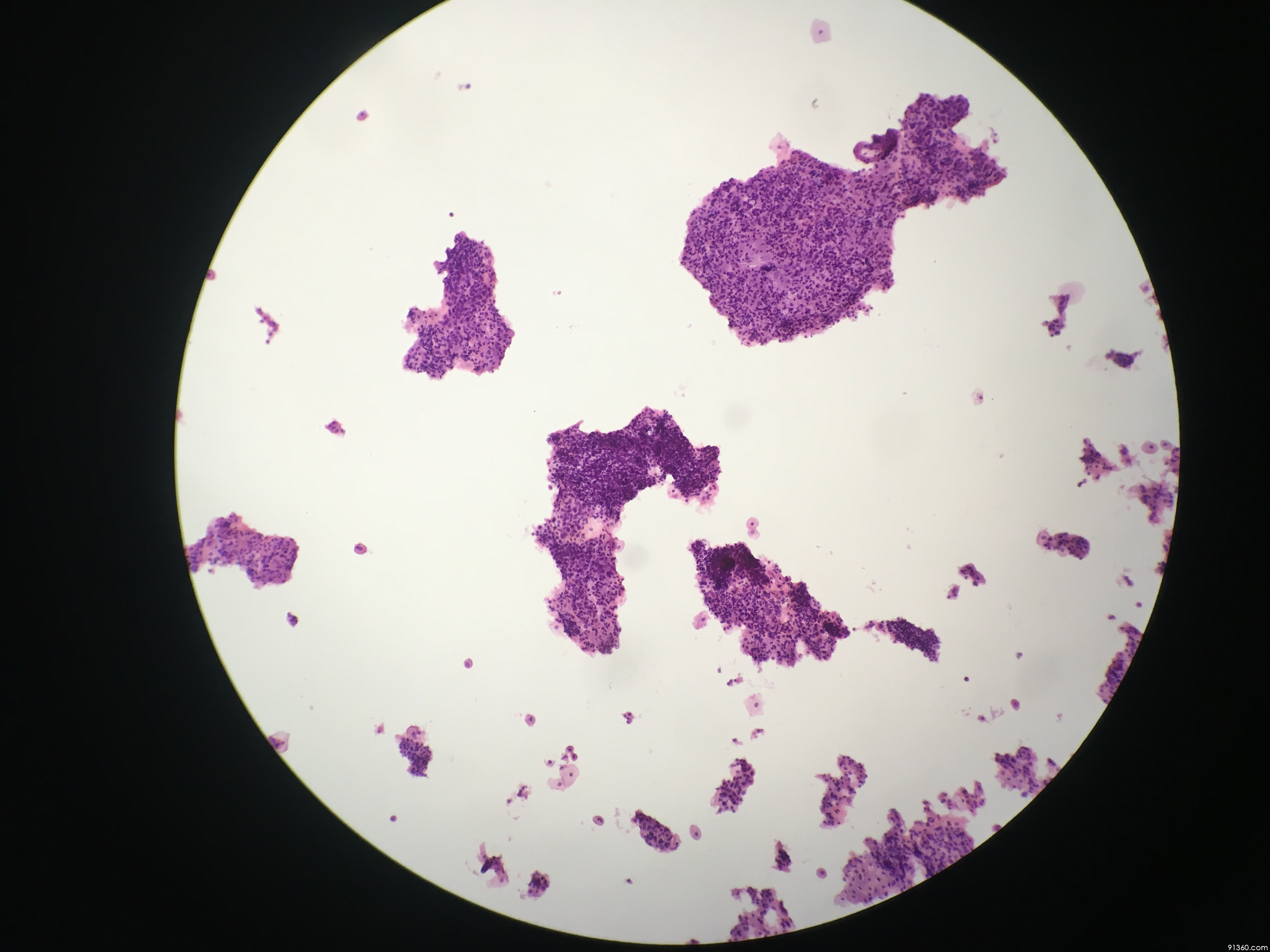 宫颈细胞有无病变