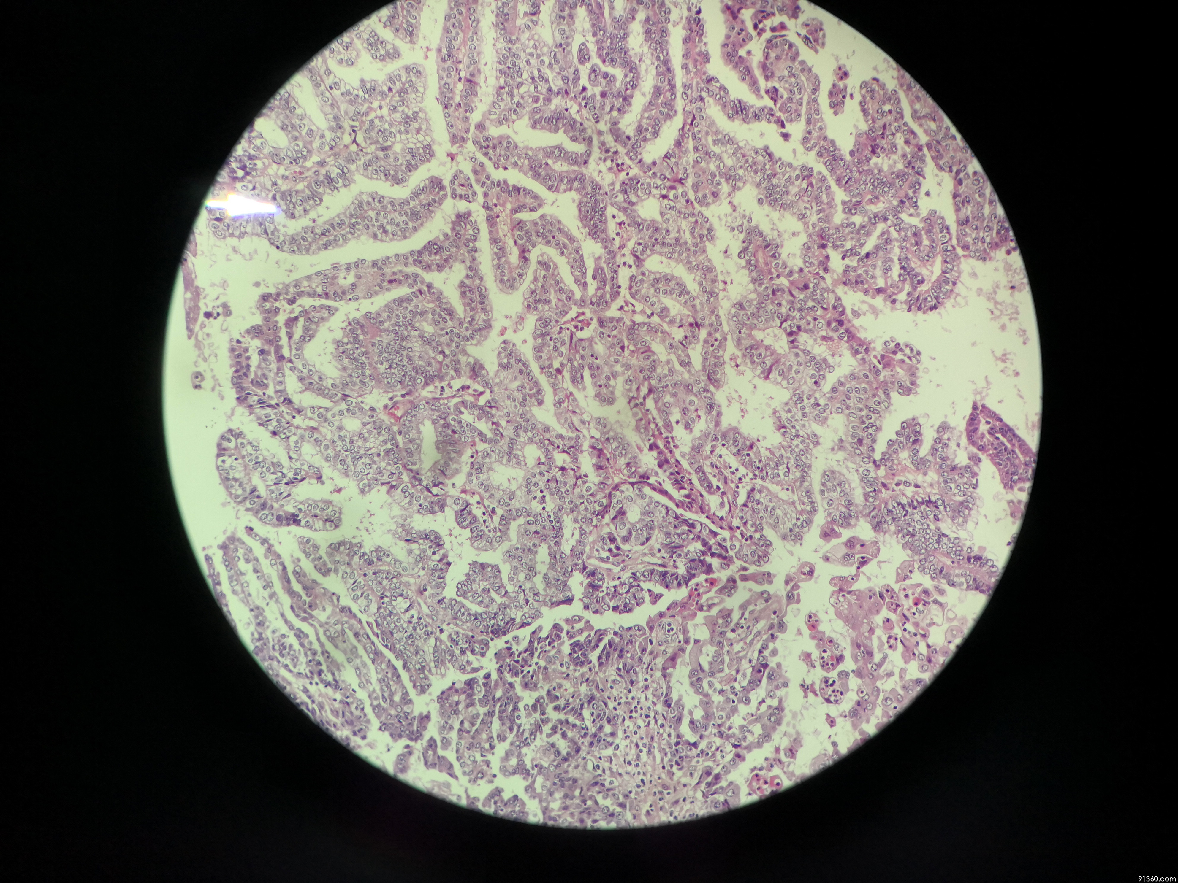 浆液性癌?讨论病例【中美加子宫内膜病理交流群501】