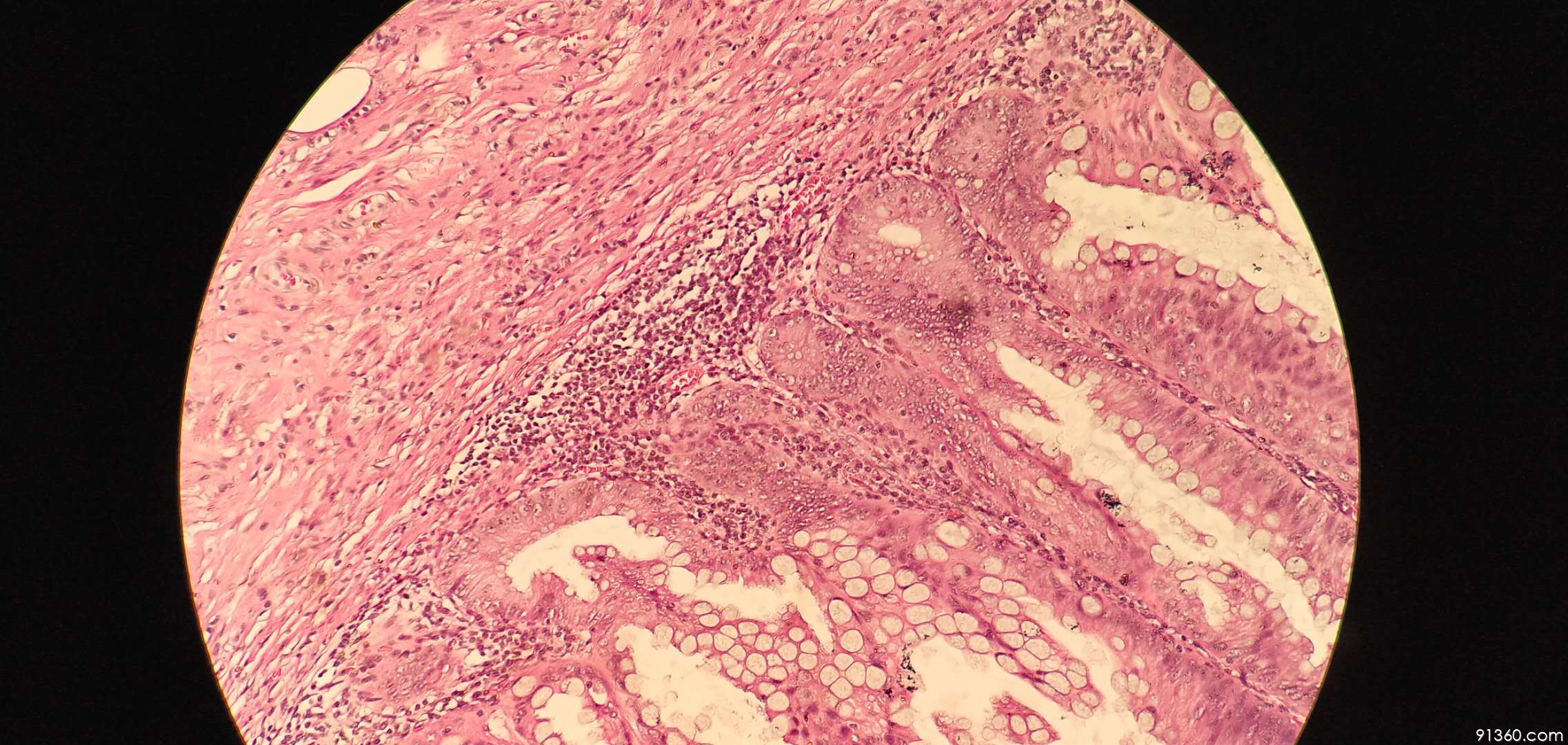 锯齿状腺瘤病例讨论2019.06.02【91360消化病理沙龙病例讨论422】