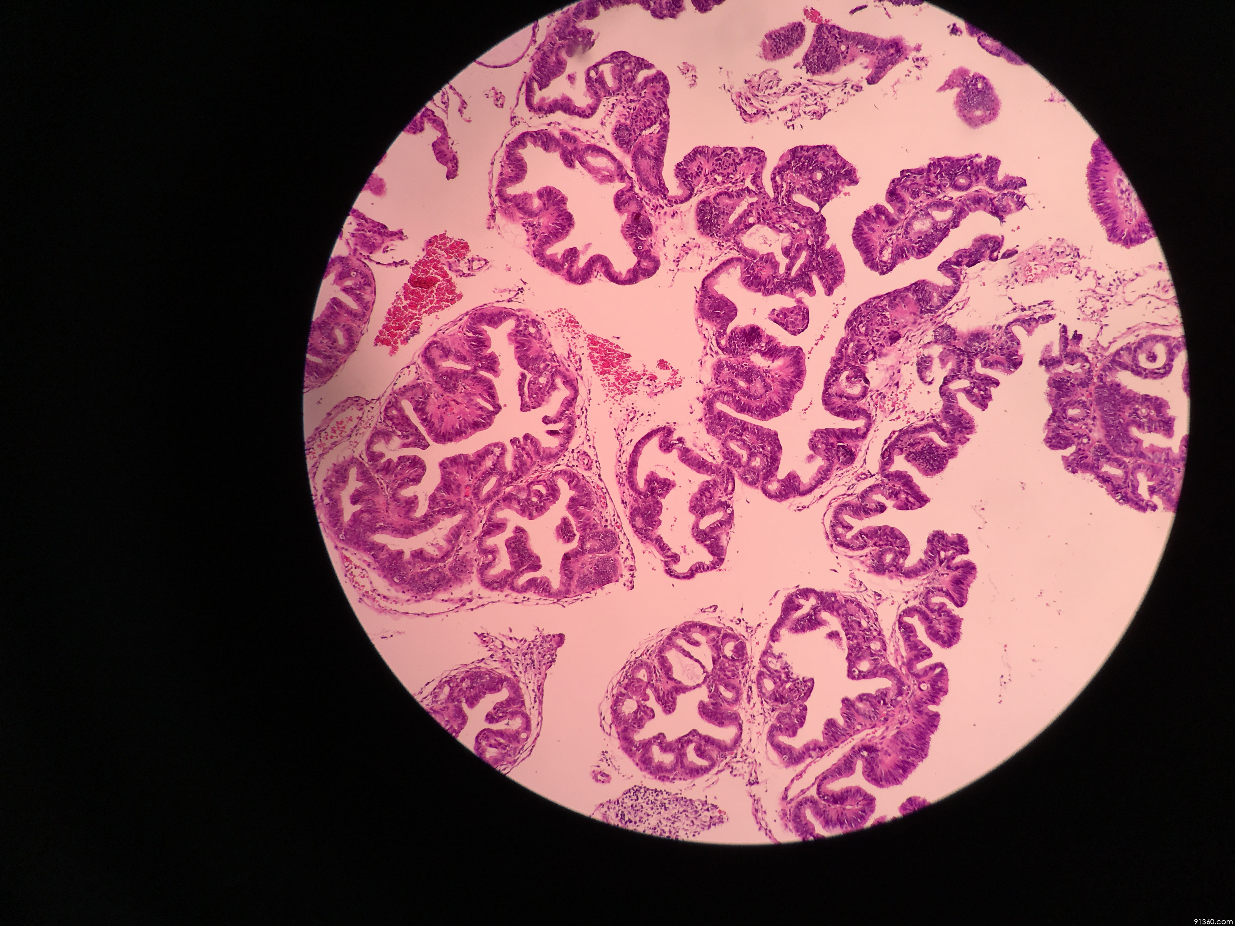 绒毛腺型腺癌?非典型增生?讨论病例【中美加子宫内膜病理交流群544】