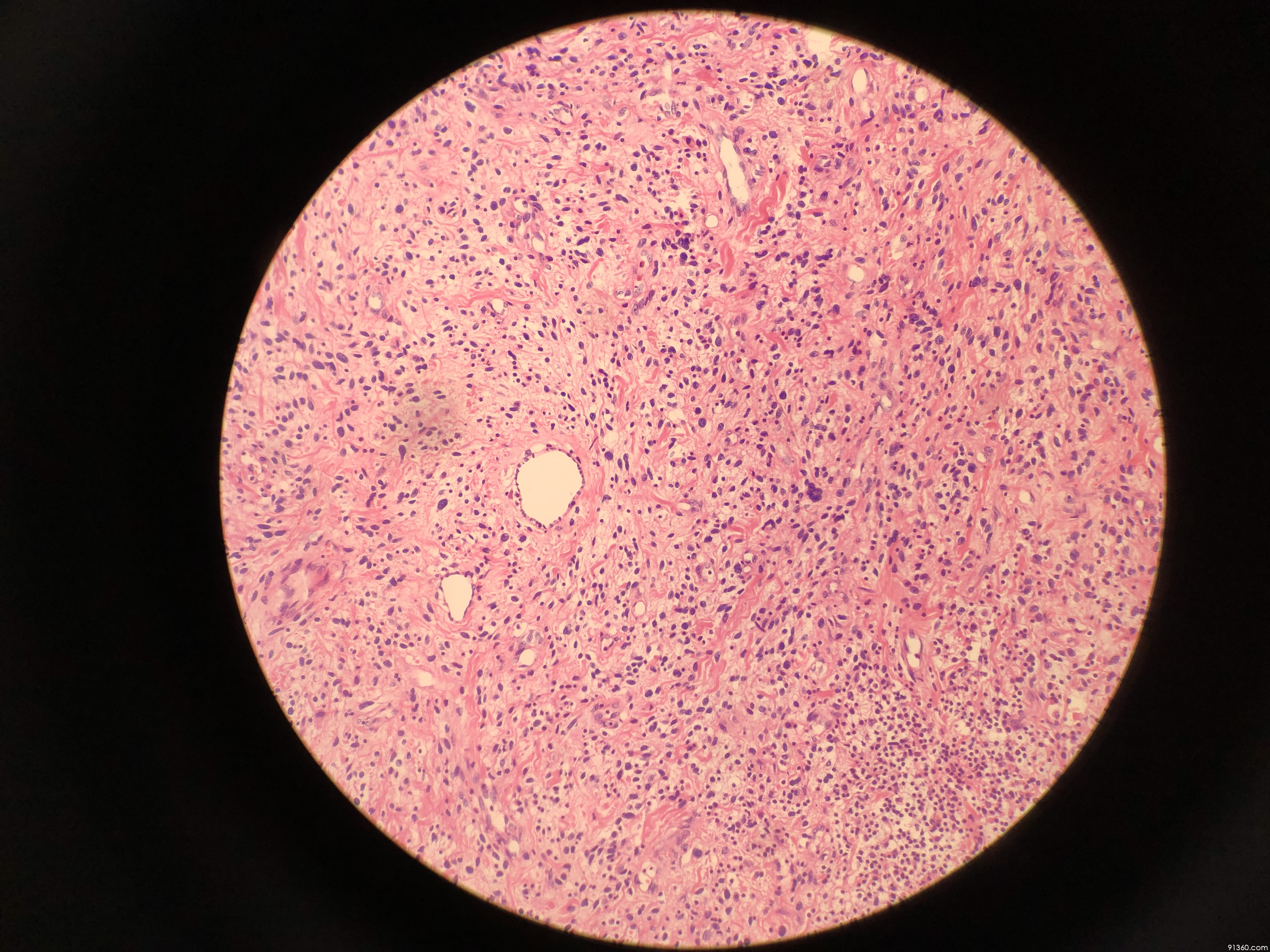 cd34阳性的纤维母细胞性肿瘤?讨论病例【91360.软组织309】