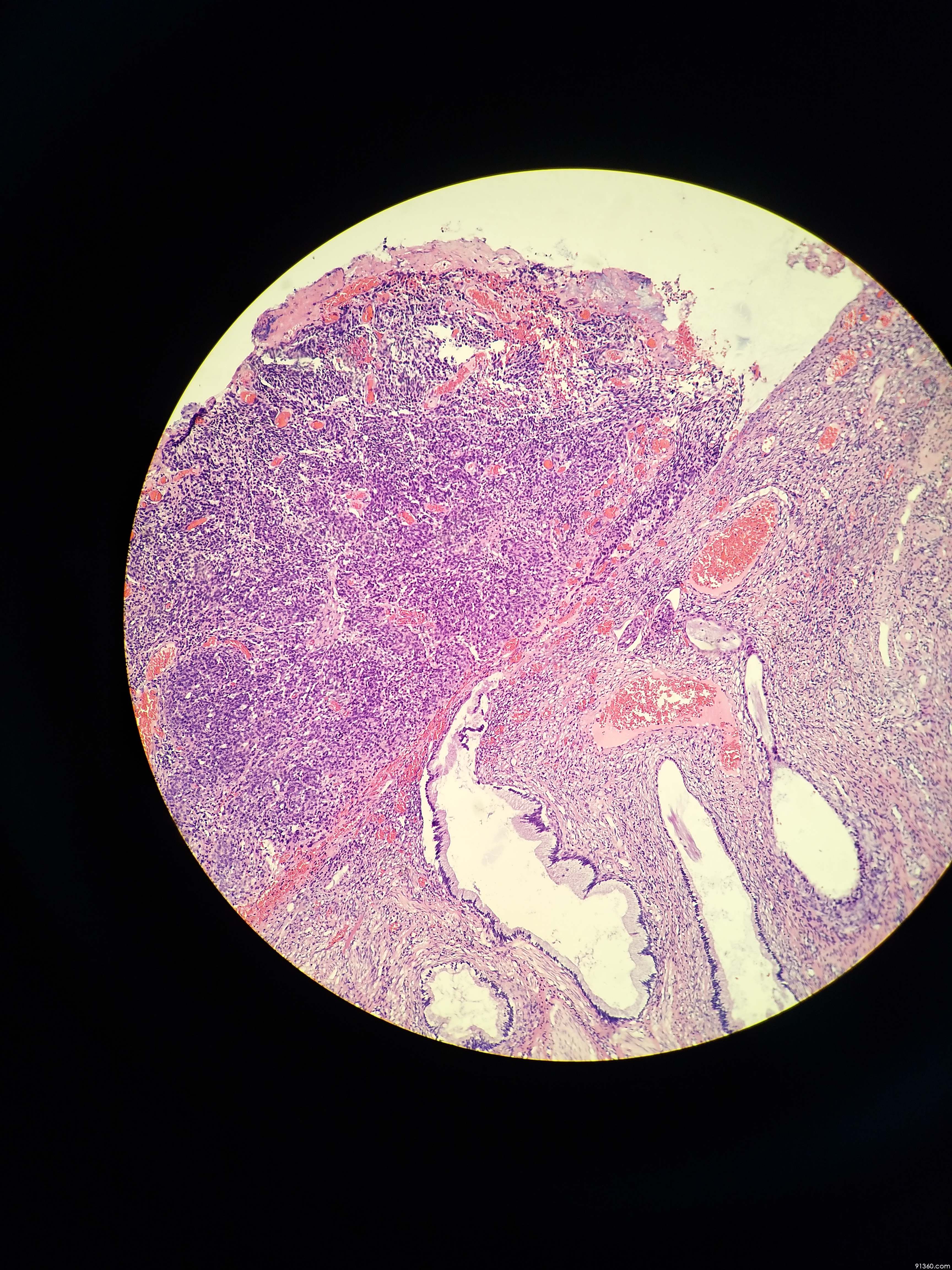 宫颈鳞癌(湿疣样癌?)【中美加宫颈病理交流群病例1155】