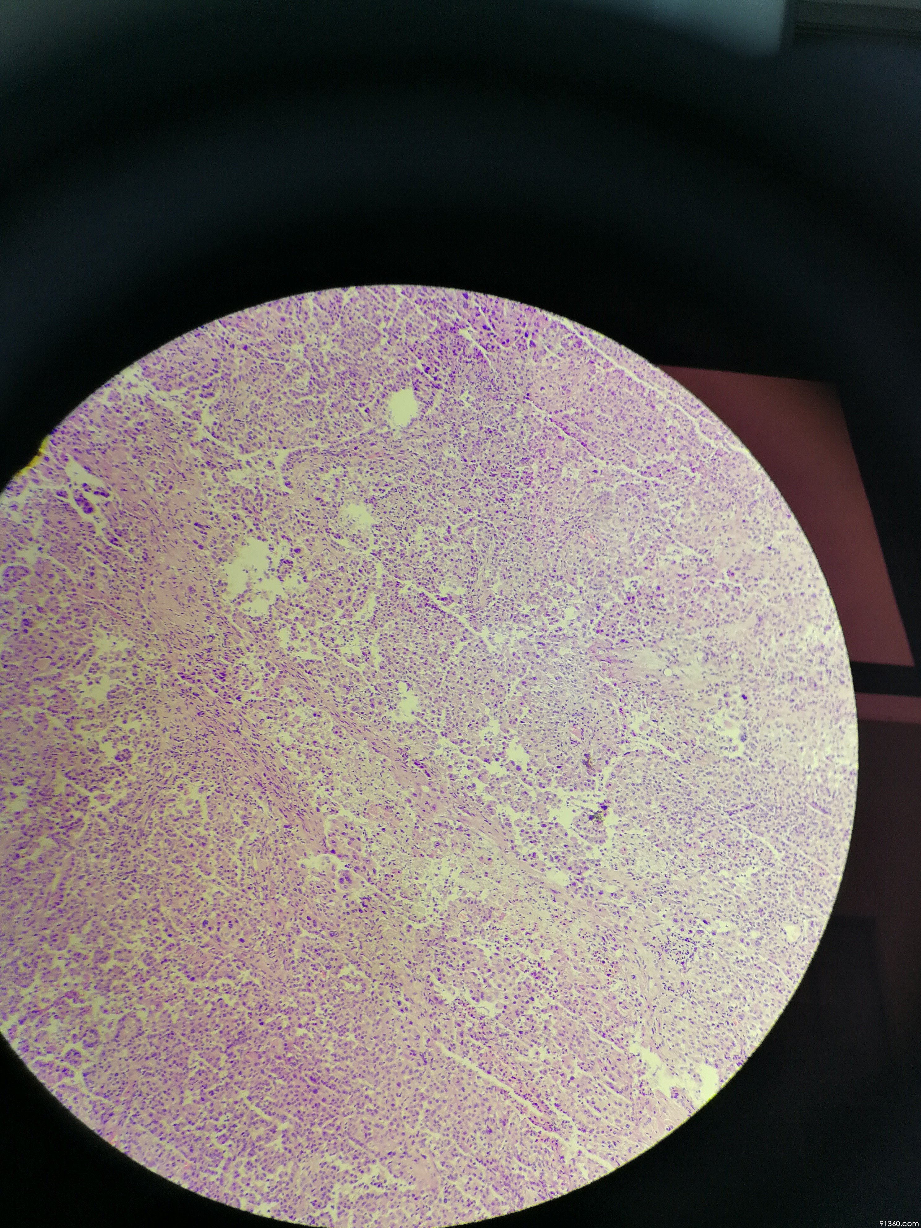 恶性间皮瘤?讨论病例【91360.软组织332】