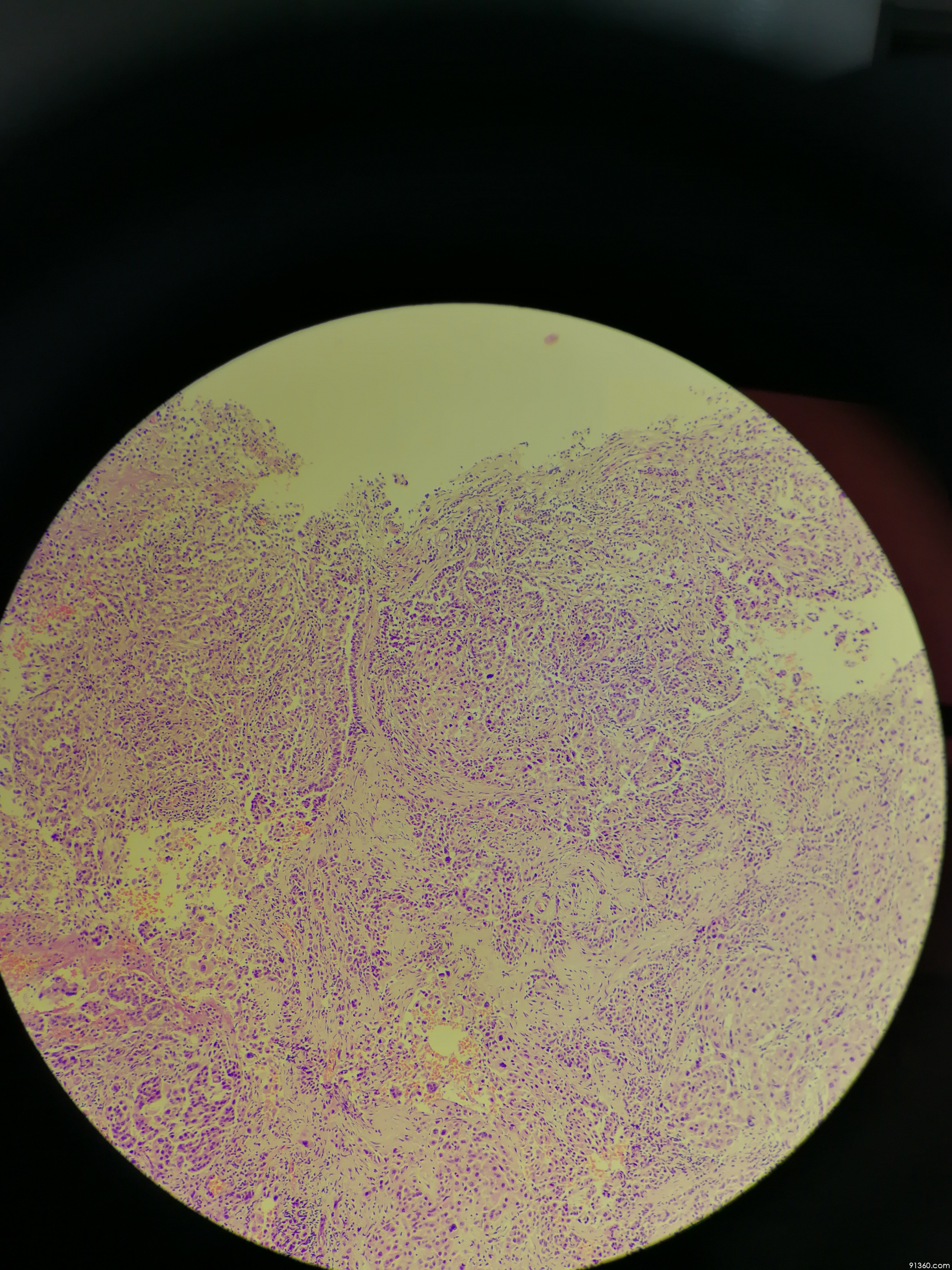 恶性间皮瘤?讨论病例【91360.软组织332】