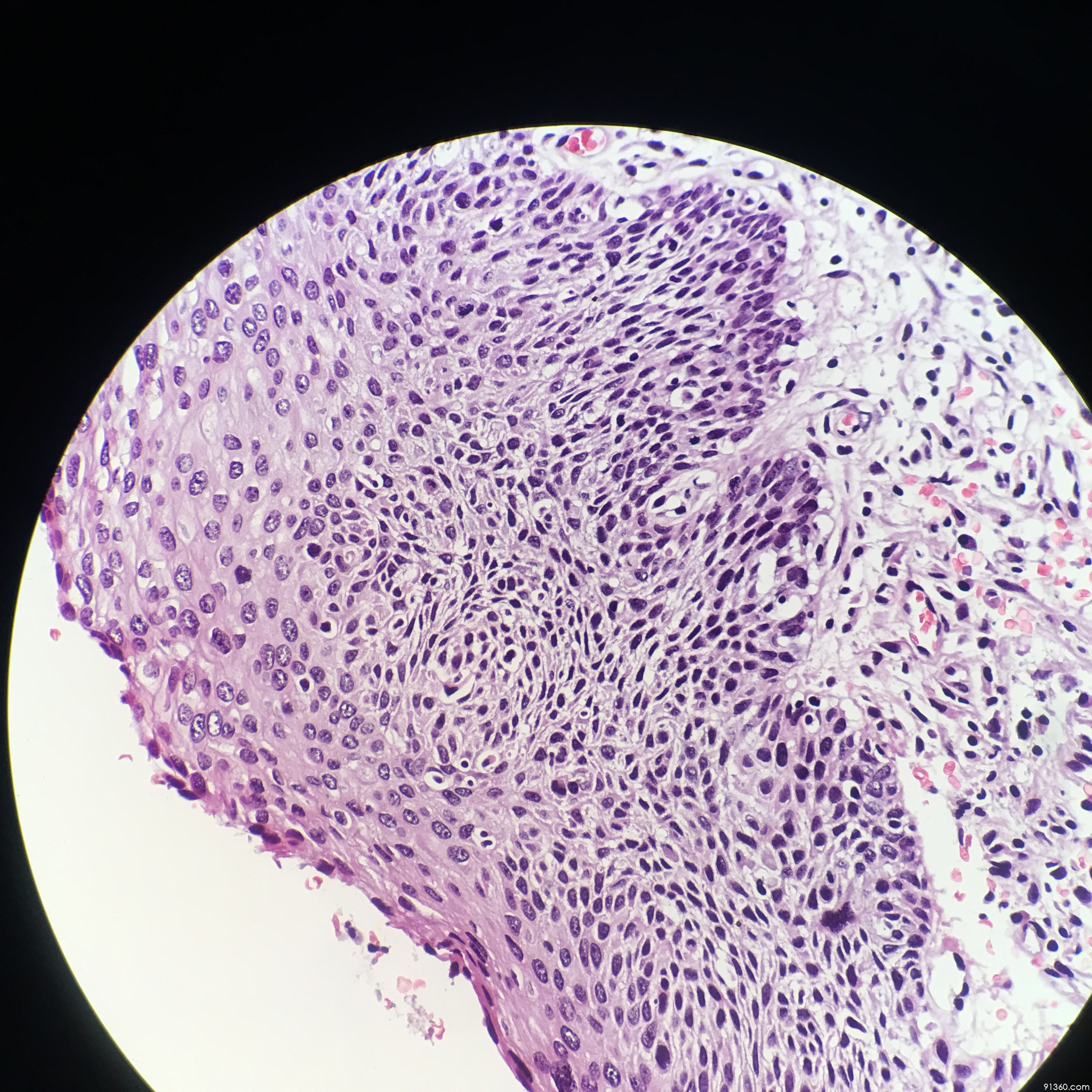 高级别【中美加宫颈病理交流群病例1175】 - 中美加宫颈病理学交流群