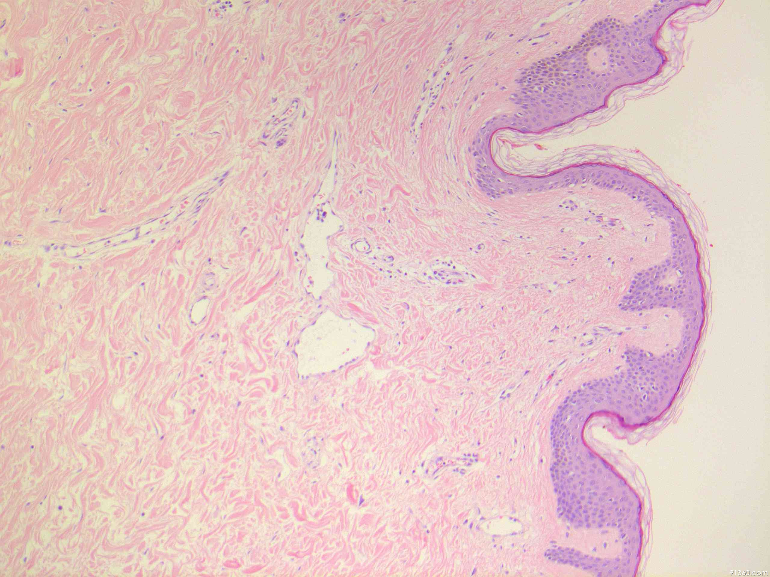 Utility Of C MYC IHC In Differentiating Radiation associated