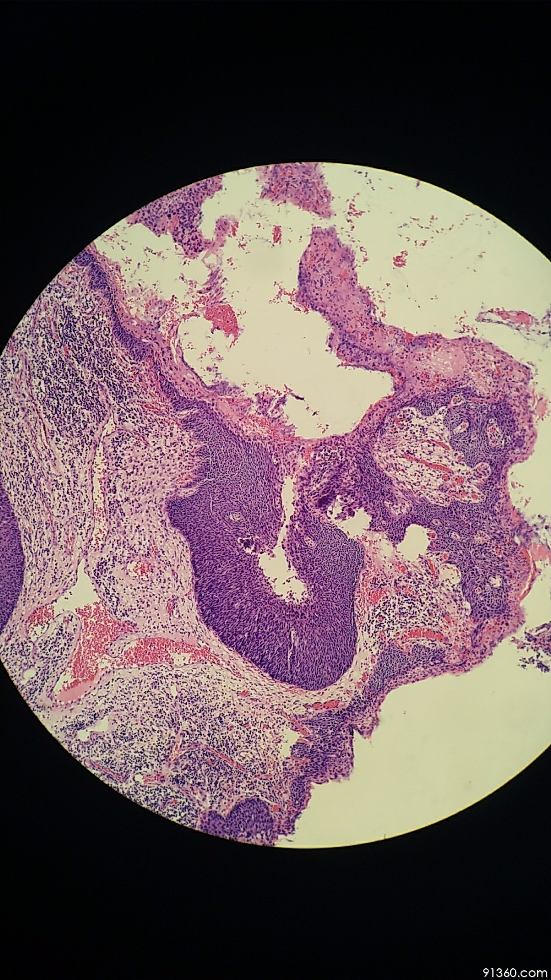 微浸润腺癌图片