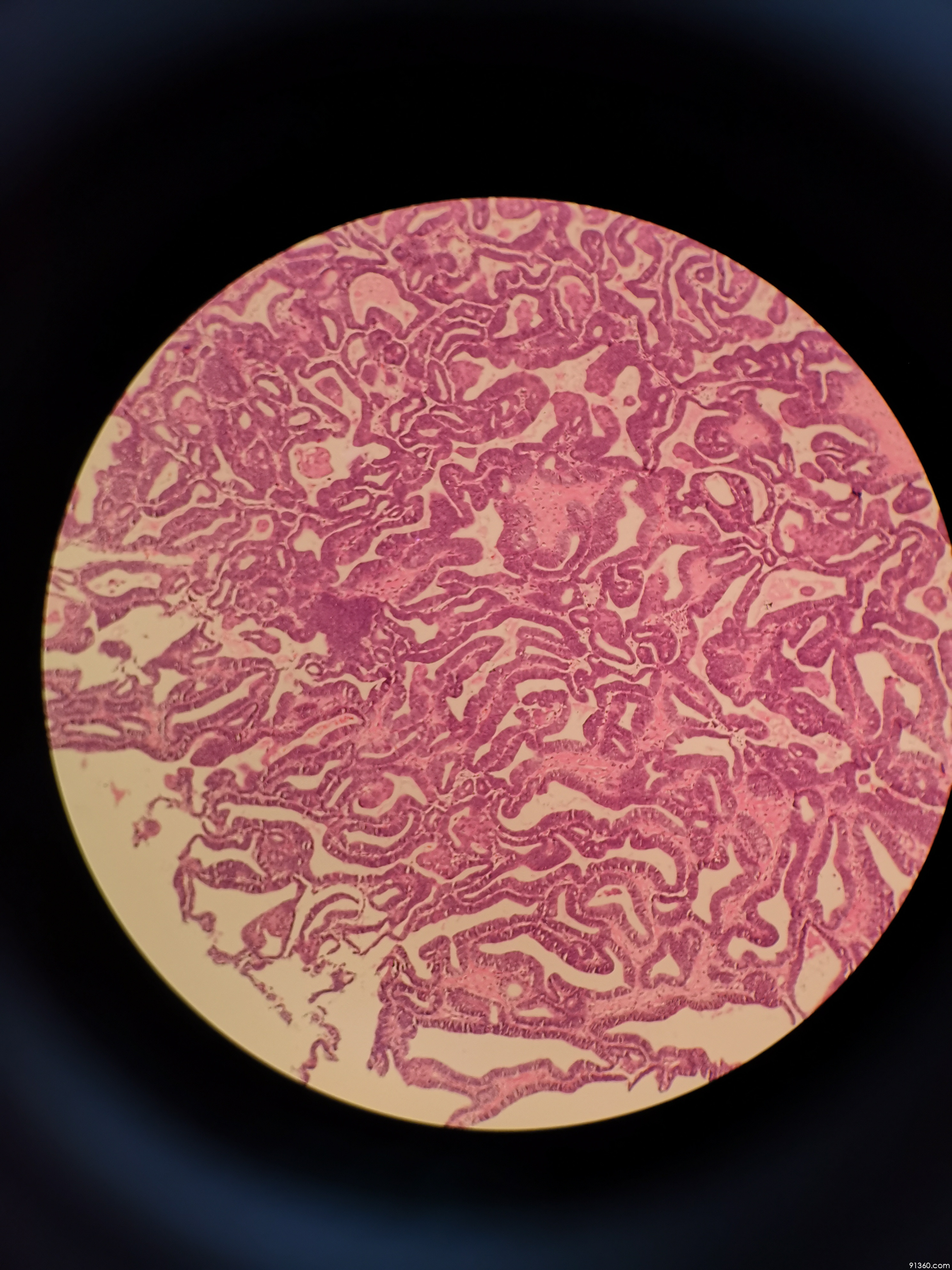 子宫内膜癌?讨论病例【中美加子宫内膜病理交流群597】