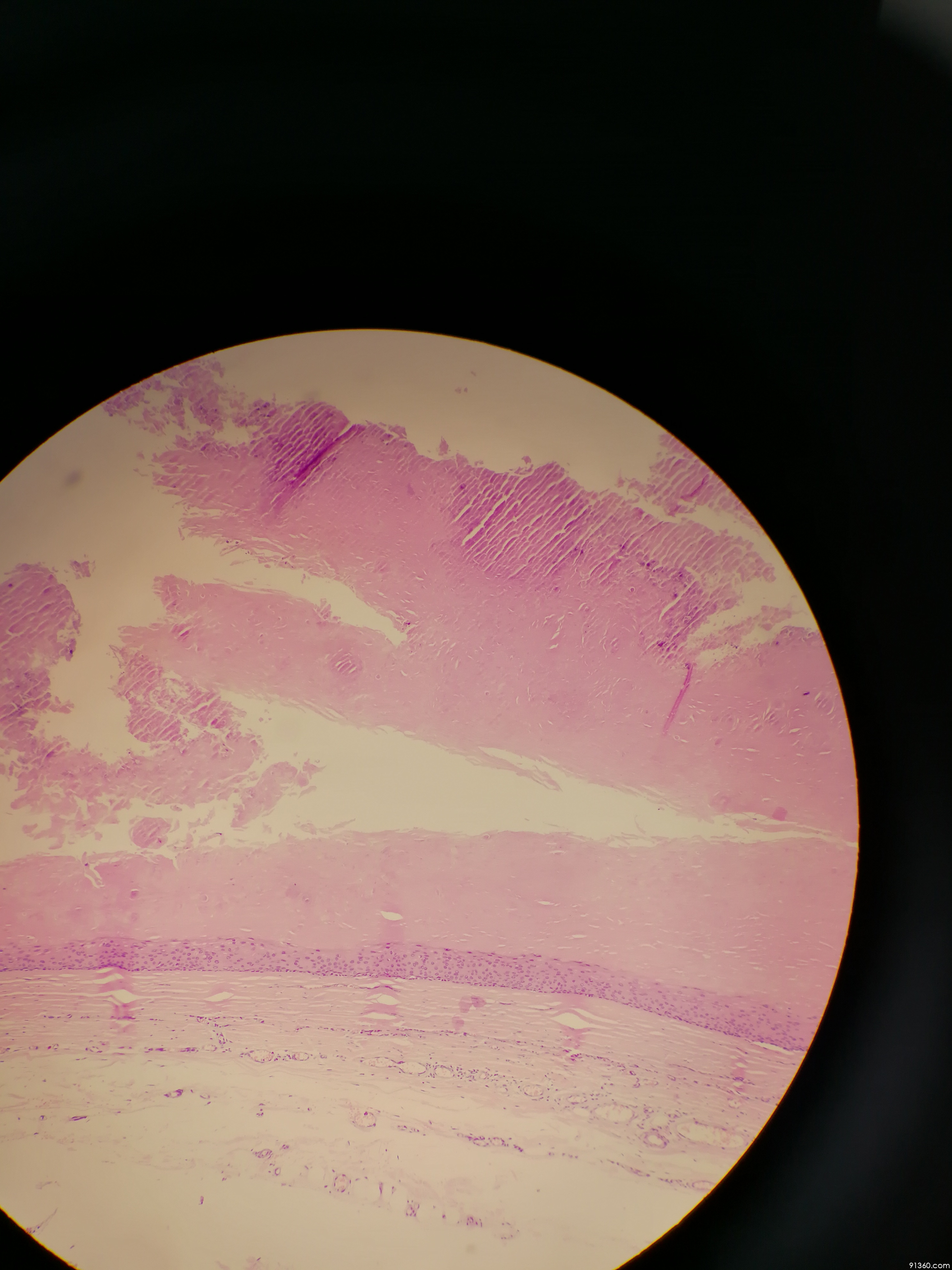 头皮,毛发囊肿?讨论病例【91360.软组织444】