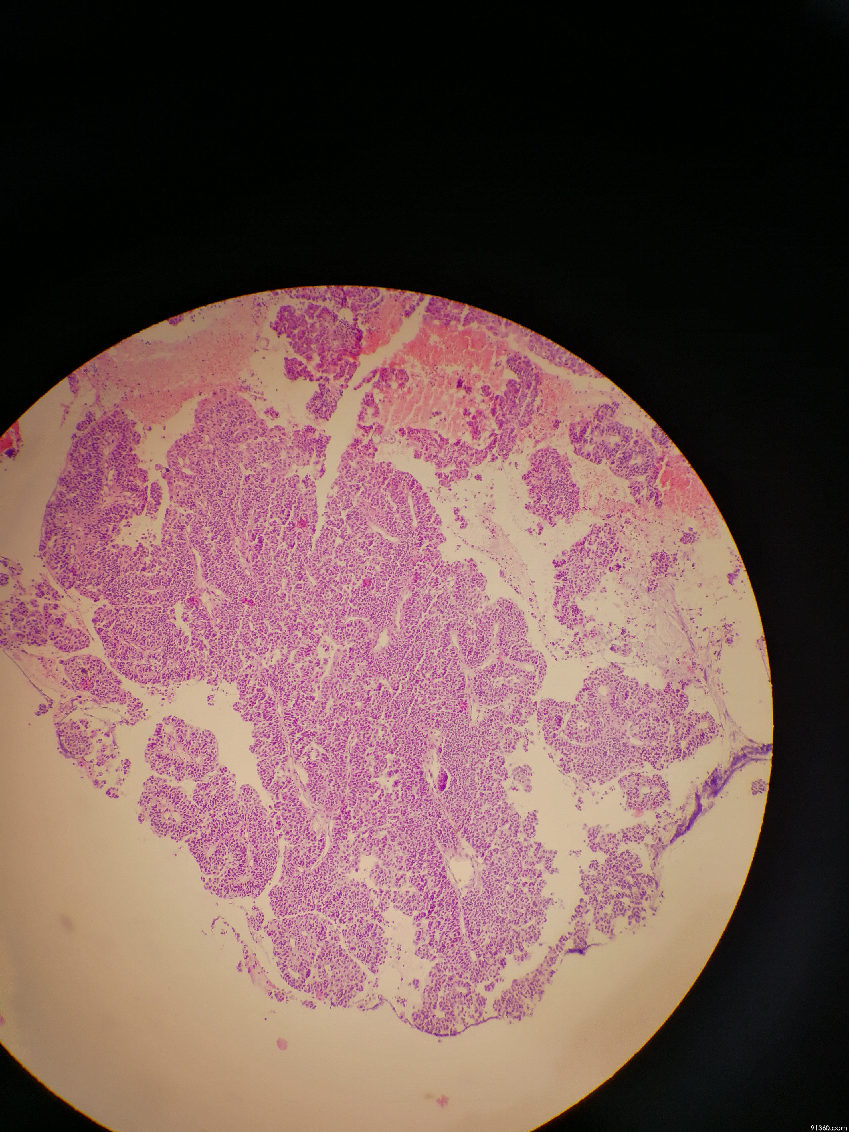 鼻腔小圆细胞肿瘤?异位垂体瘤?嗅母?讨论病例【91360.软组织475】