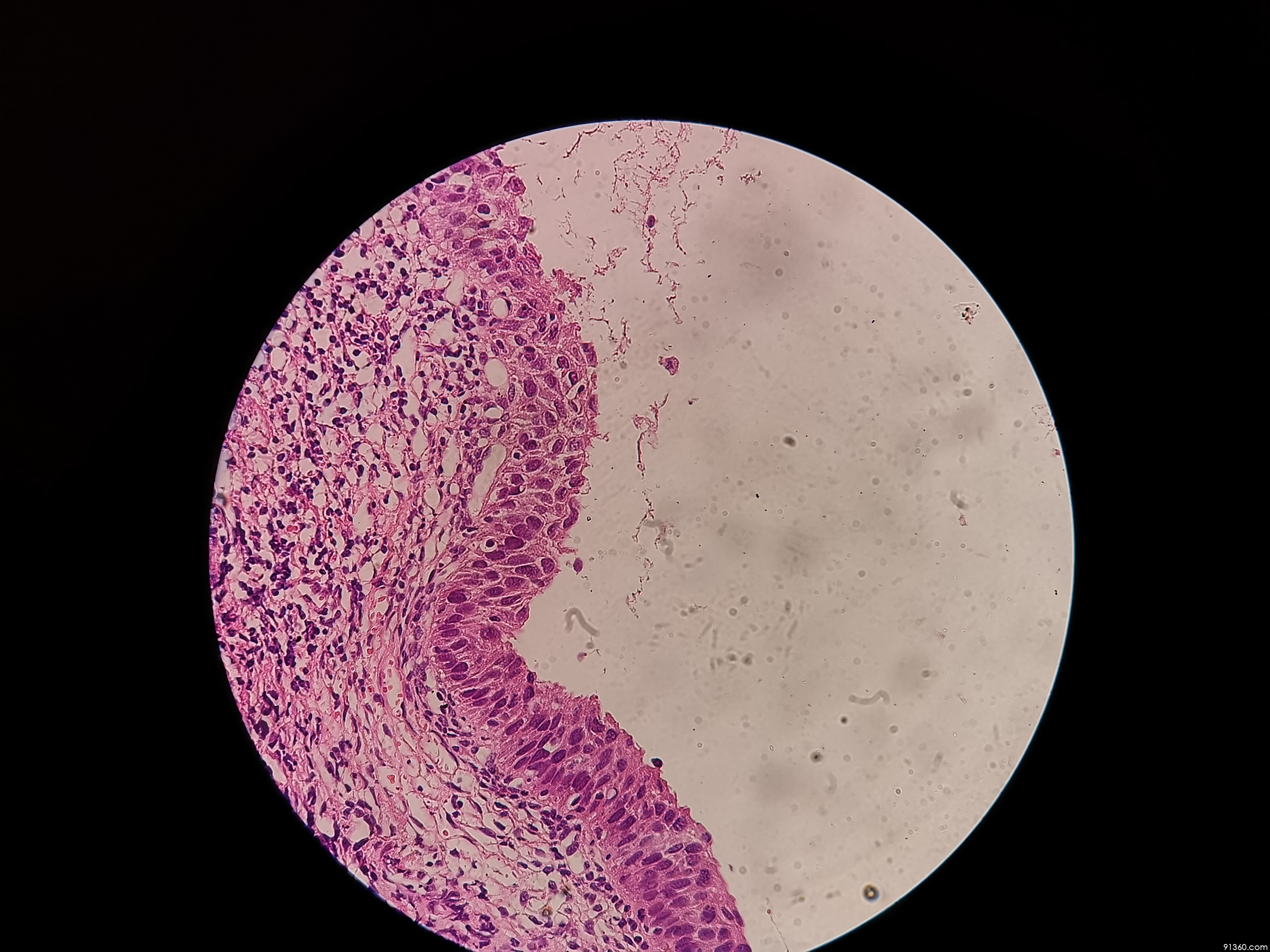 宫颈高级别?萎缩?【中美加宫颈病理交流群病例1271】