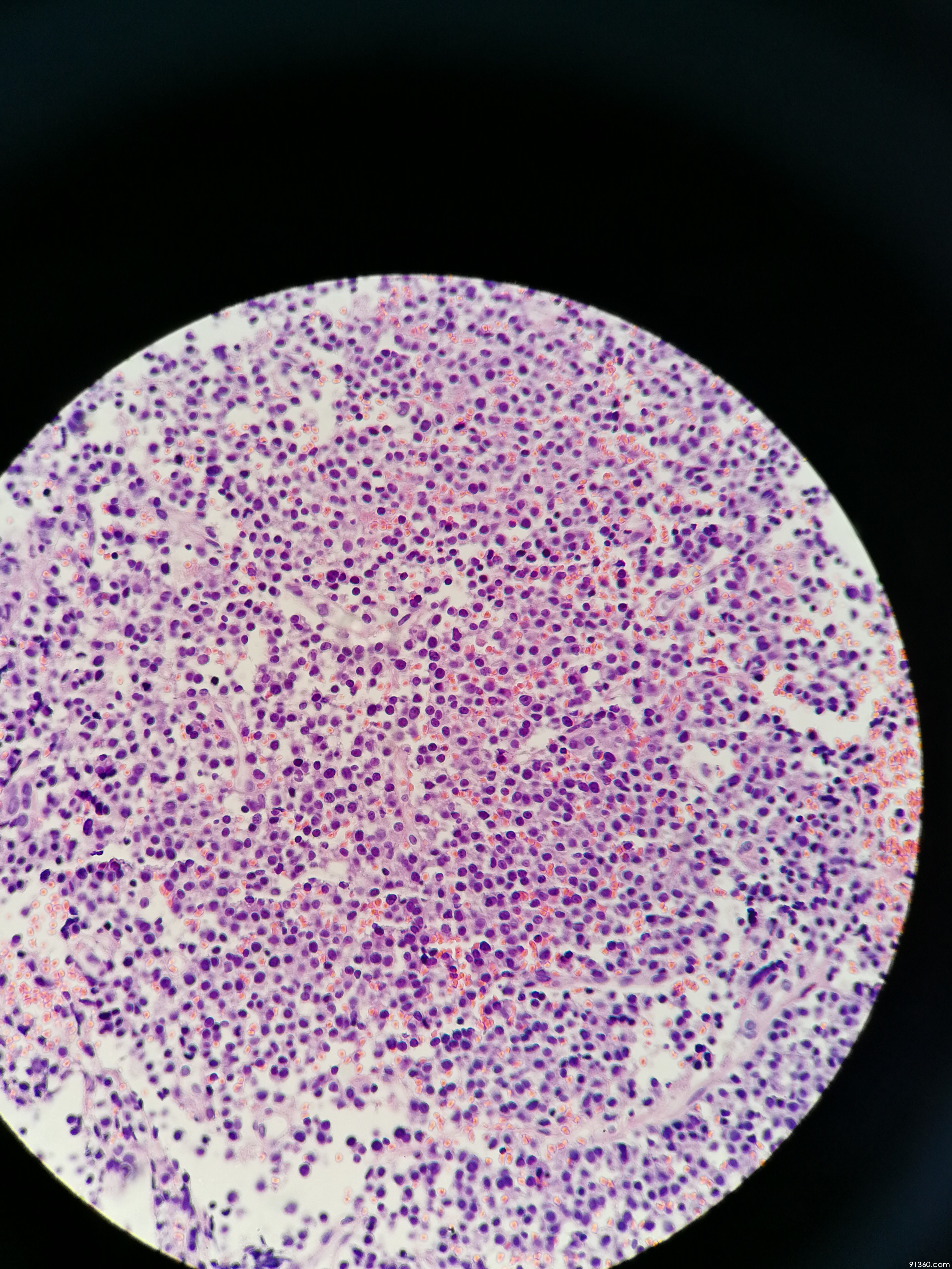 右髂骨:浆细胞骨髓瘤?讨论病例【91360.软组织542】