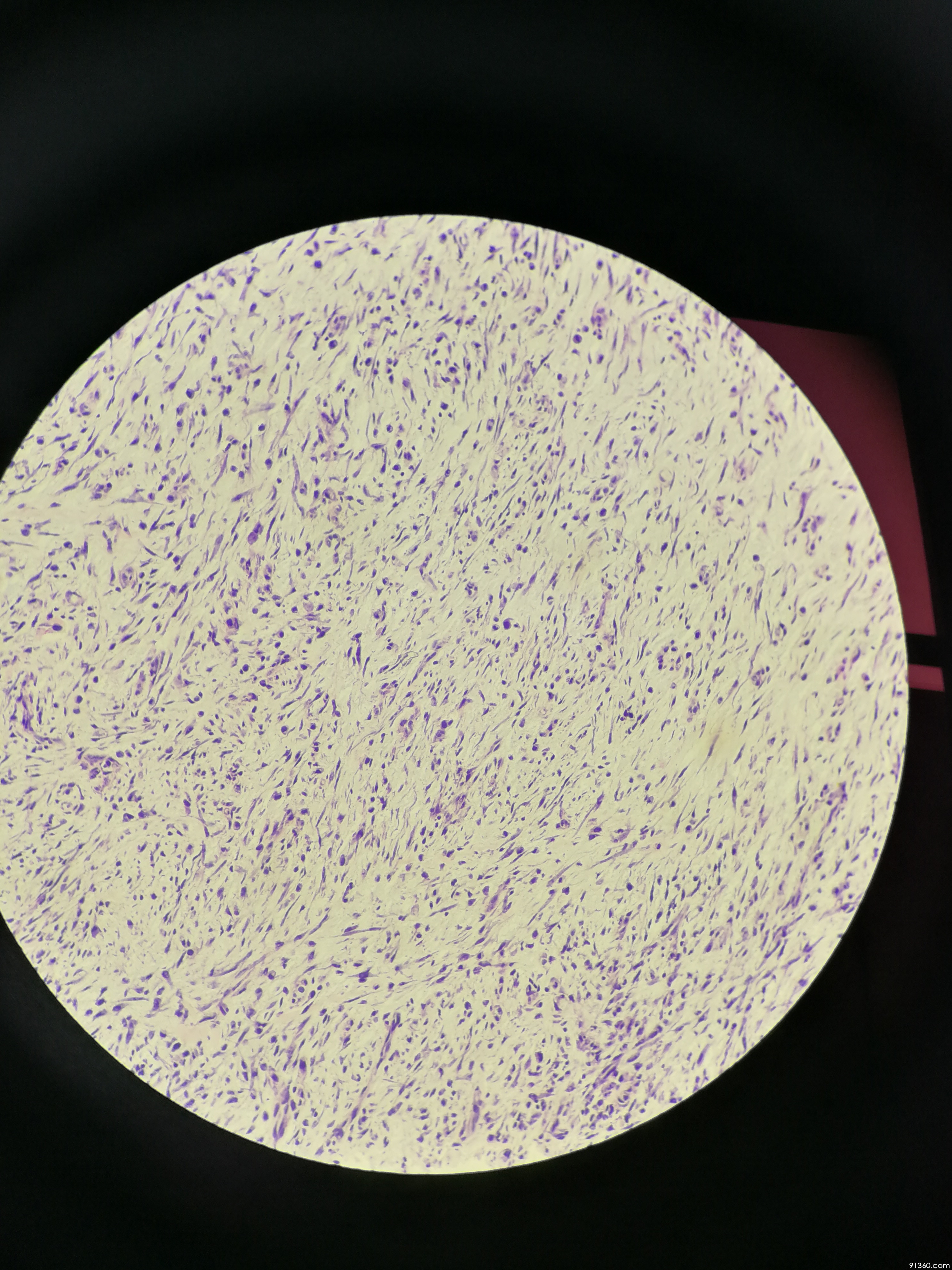 乳腺:梭形细胞肿瘤?化生性癌?结节性筋膜炎?讨论病例【91360.