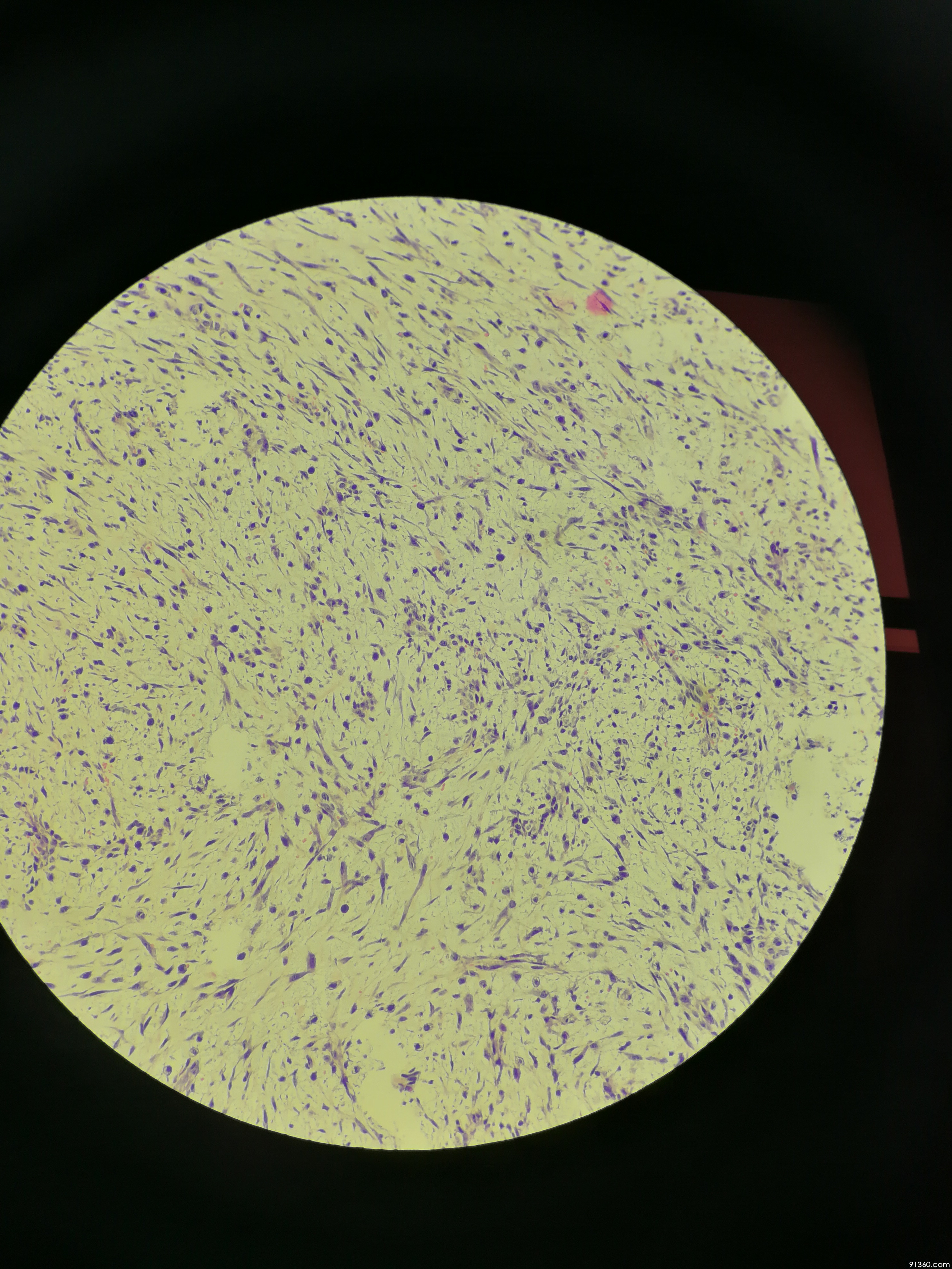 乳腺:梭形细胞肿瘤?化生性癌?结节性筋膜炎?讨论病例【91360.