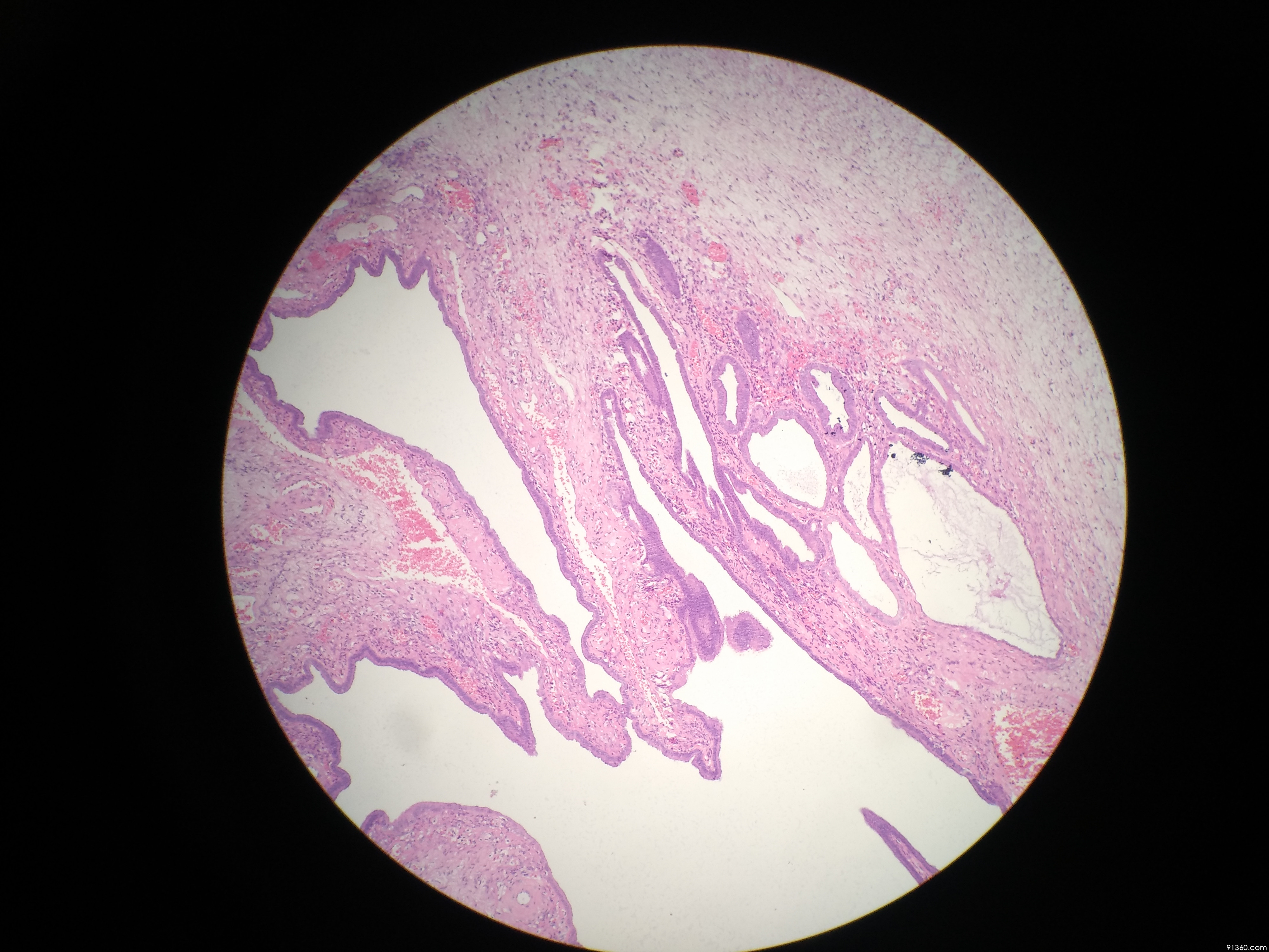 卵巢:子宫内膜样癌伴鳞状分化【中美加卵巢肿瘤病理交流群480】