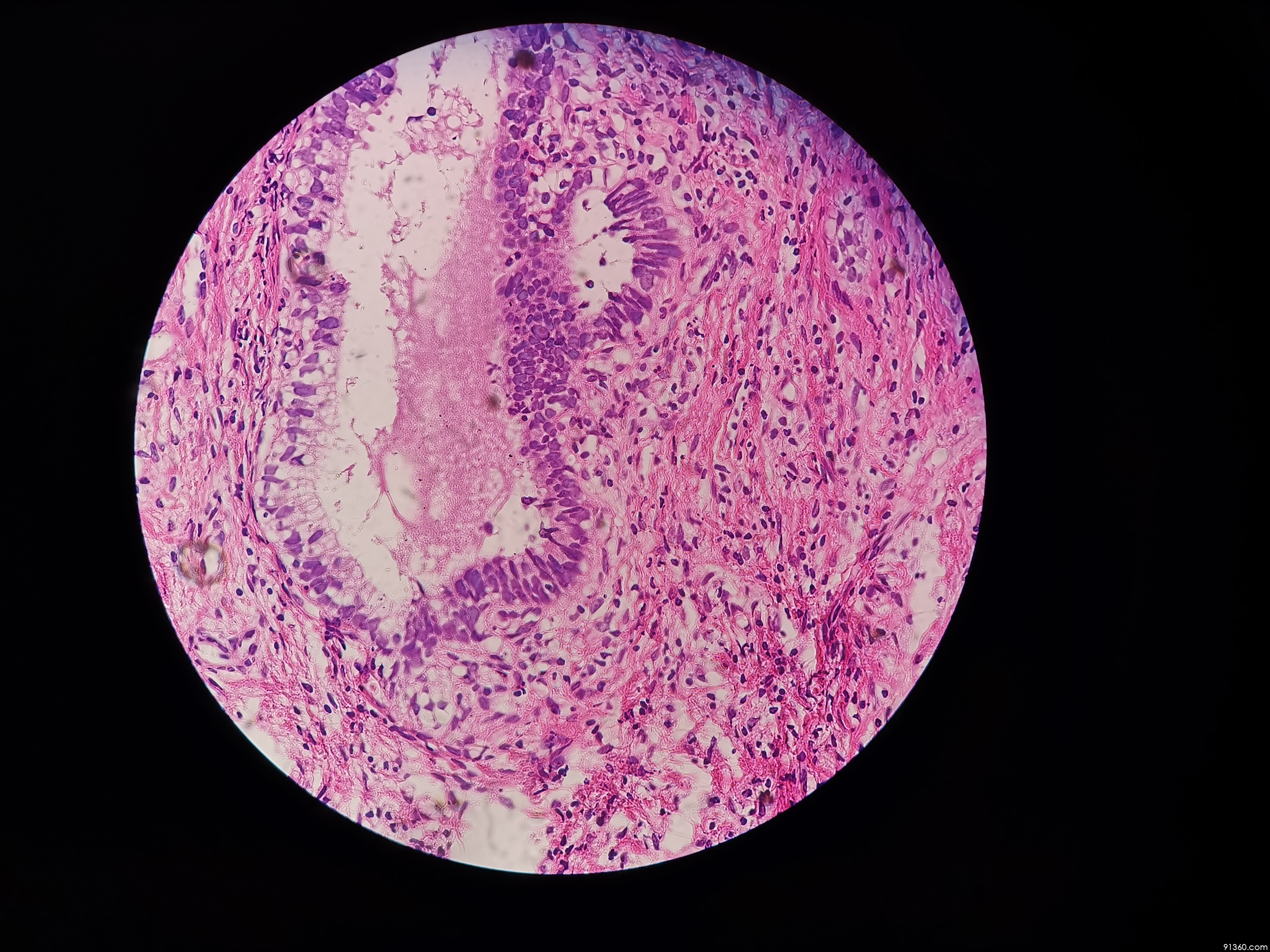 宫颈tct:agc,绒毛管状腺癌?【中美加宫颈病理交流群病例1344】