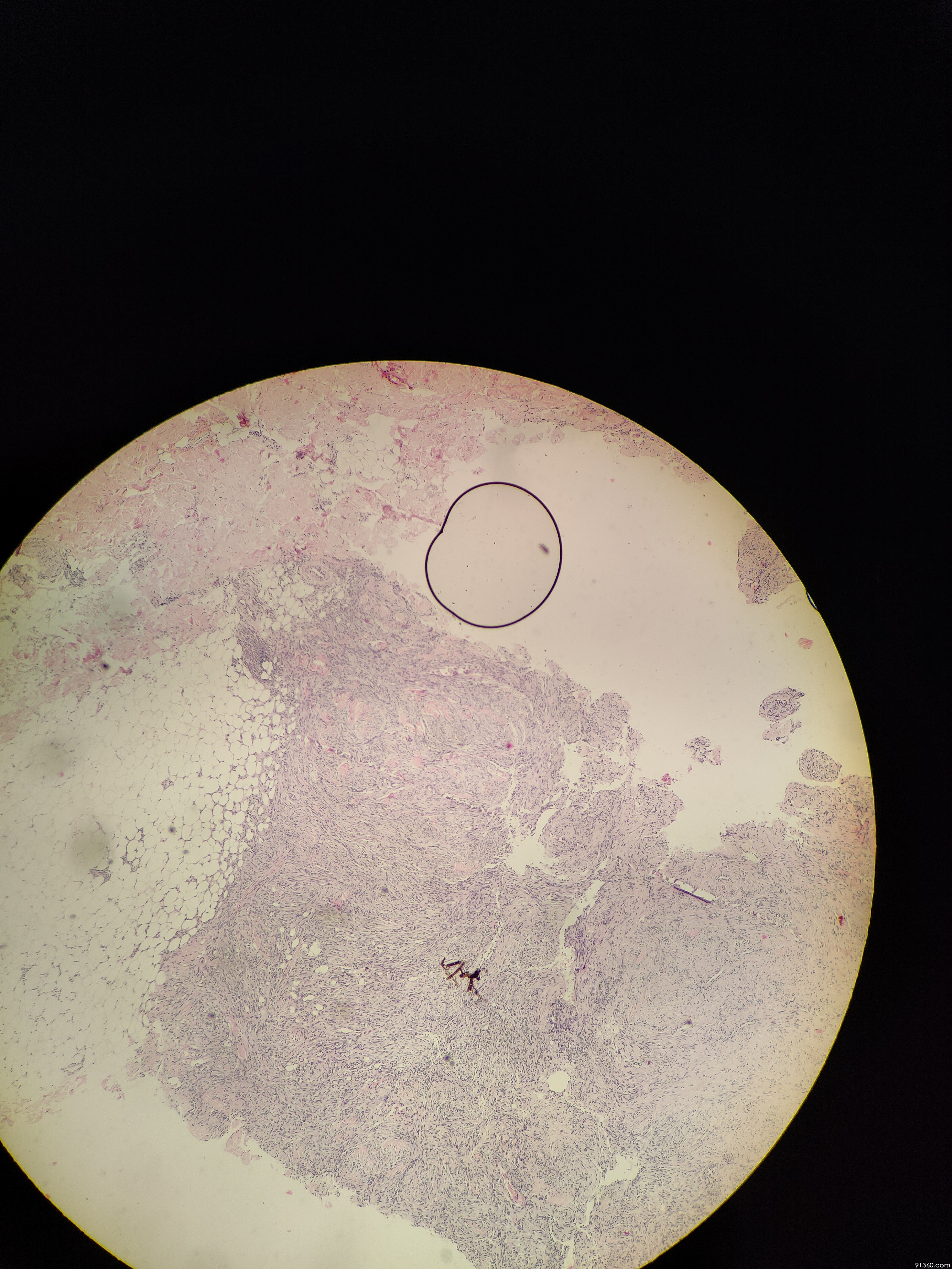 背部:细胞性纤维组织细胞瘤?讨论病例【91360.软组织652】