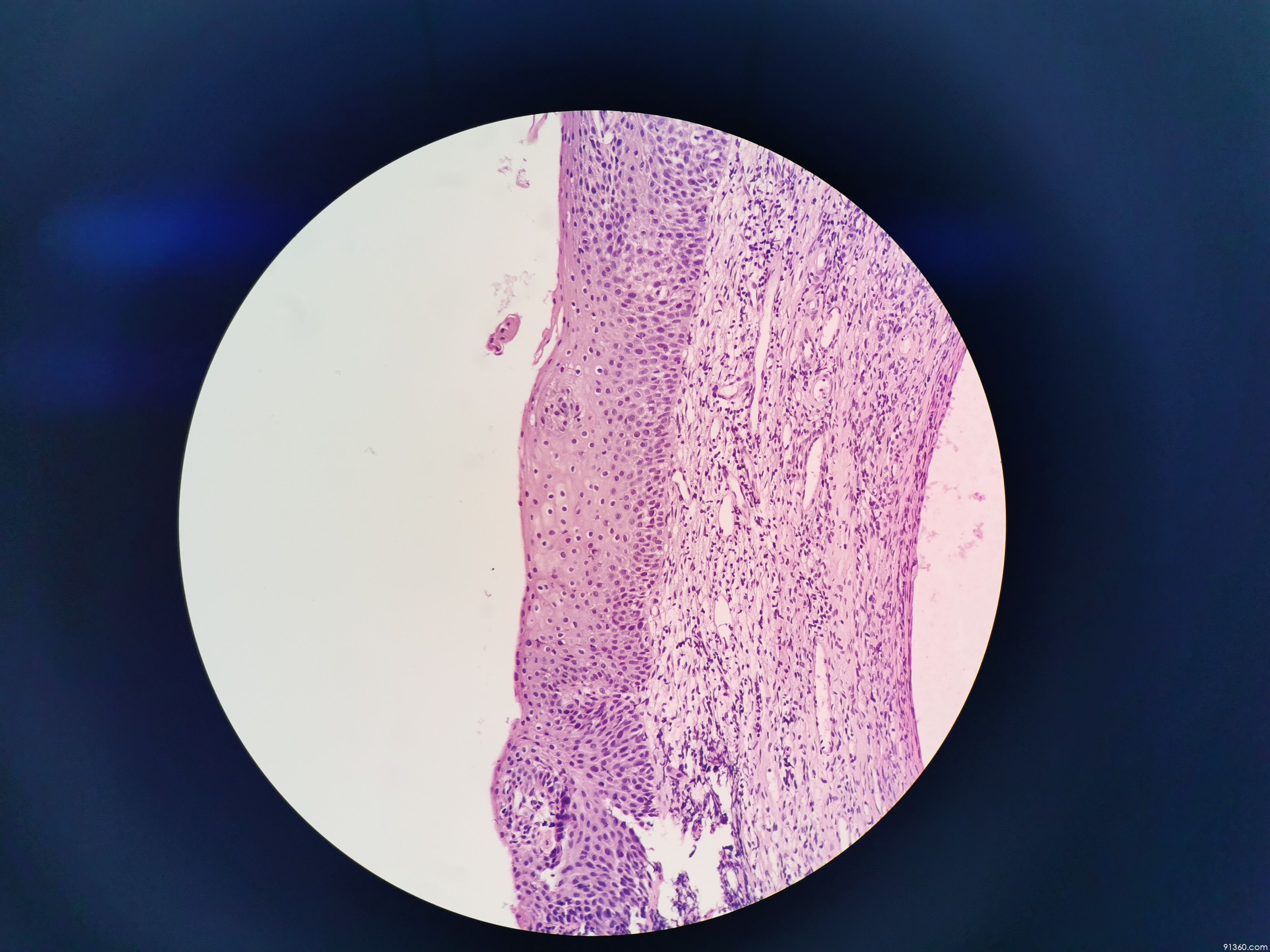 宫颈赘生物:萎缩,低级别?【中美加宫颈病理交流群病例1360】
