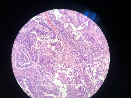 子宫内膜癌分类型 - 病例分析 - 91360病理论坛