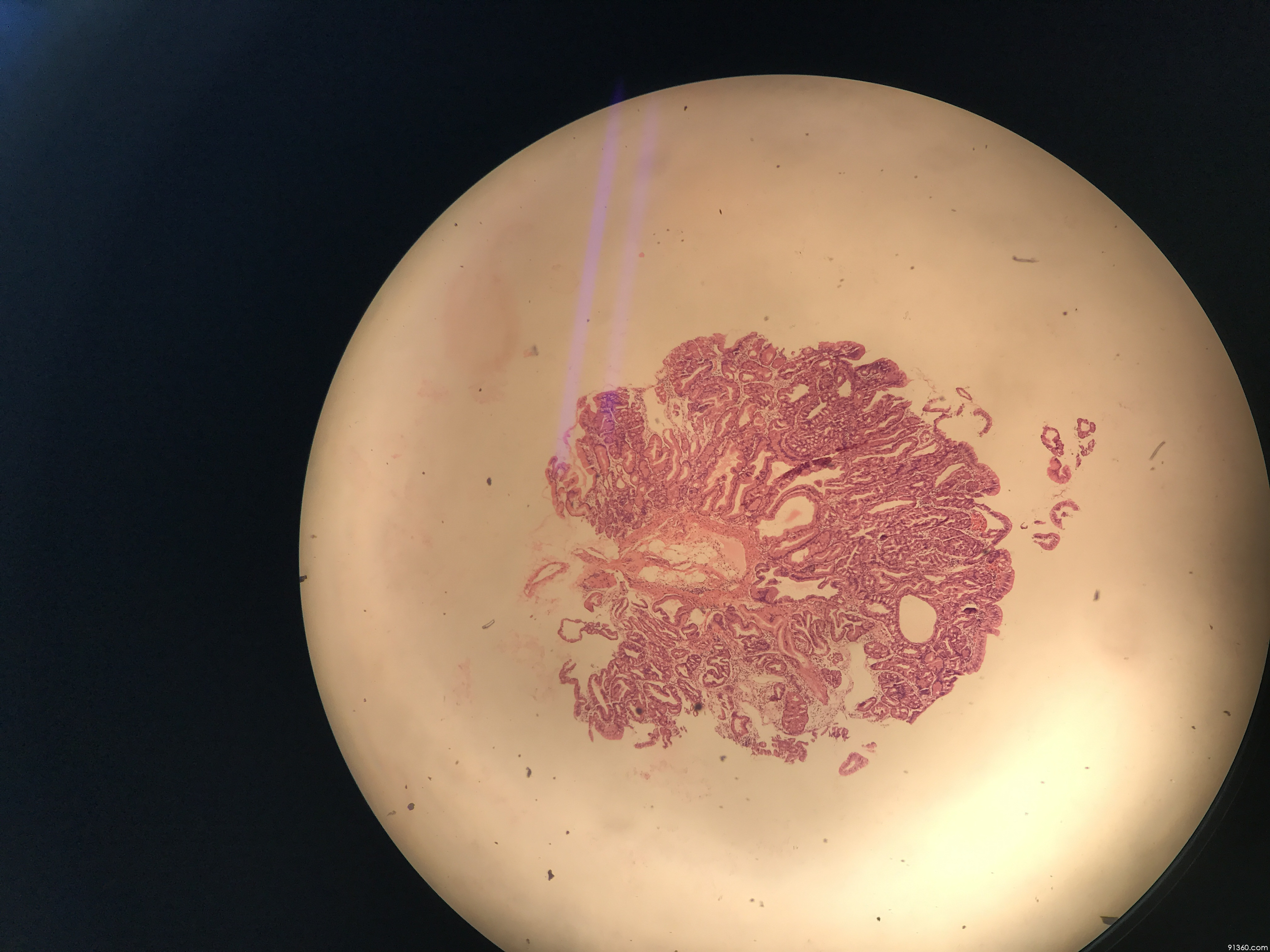 讨论病例【山东省消化道早癌病理群137】