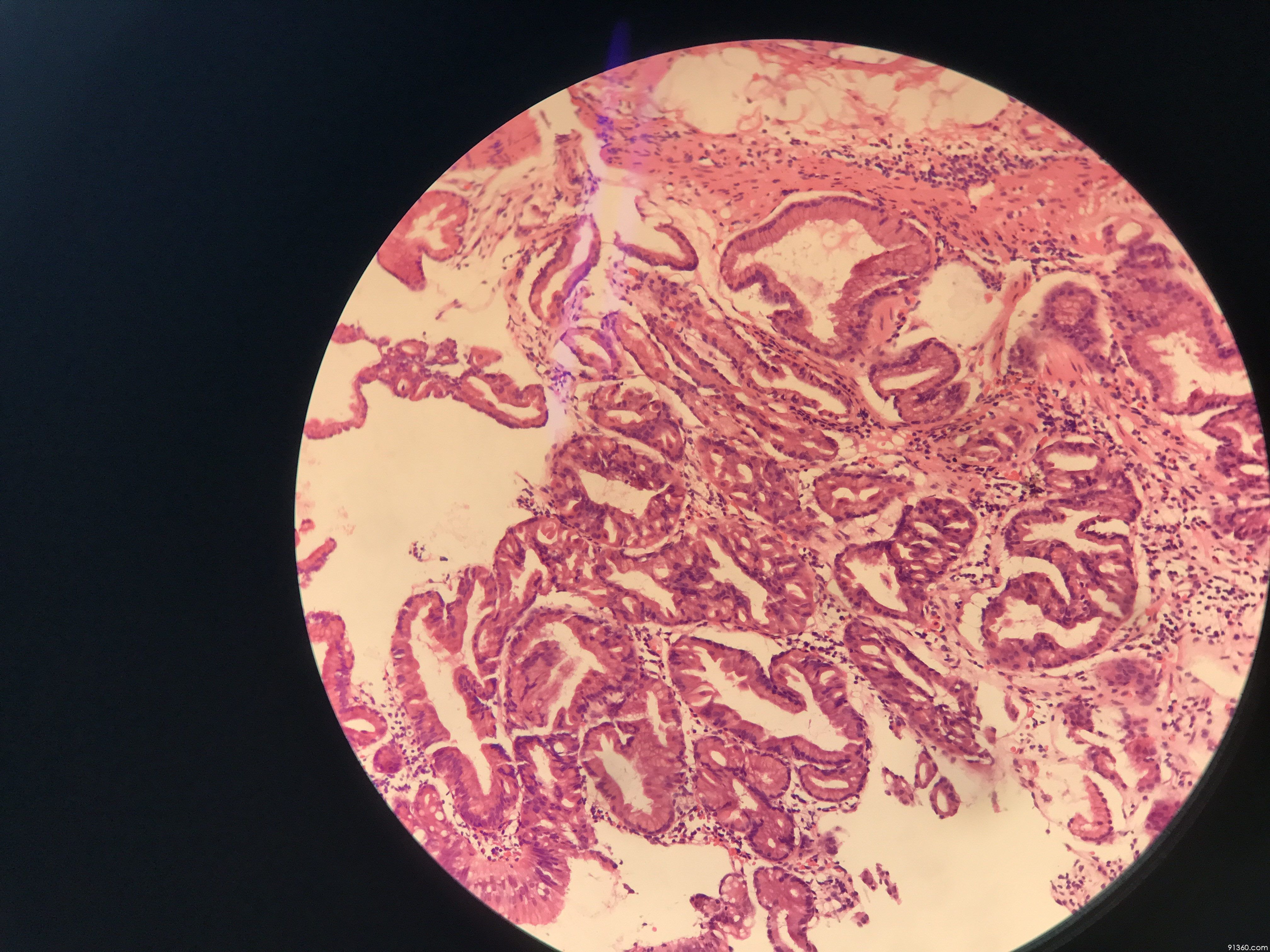 讨论病例【山东省消化道早癌病理群137】