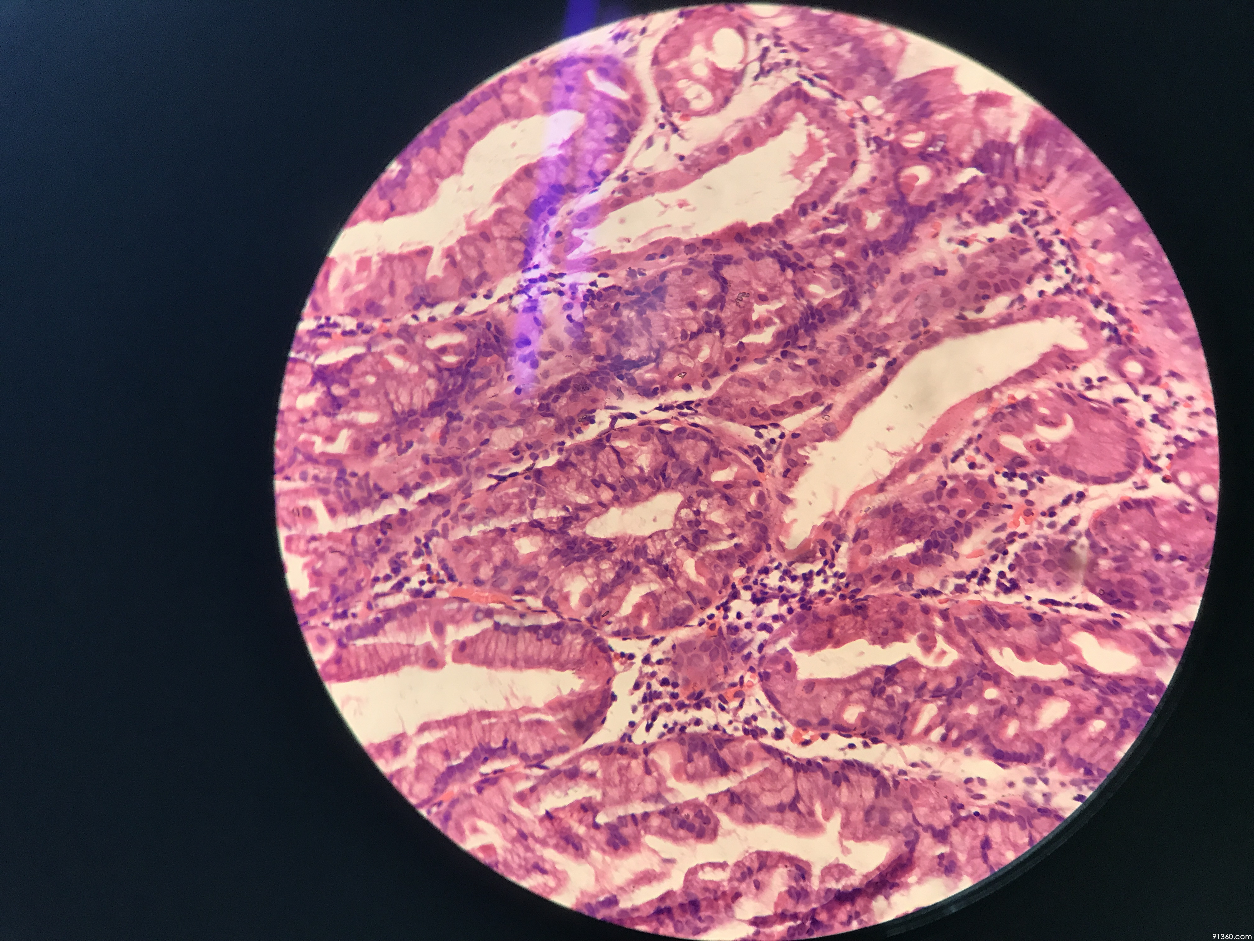 讨论病例【山东省消化道早癌病理群137】