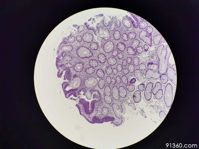 结肠广基1.5厘米息肉:管状腺瘤?