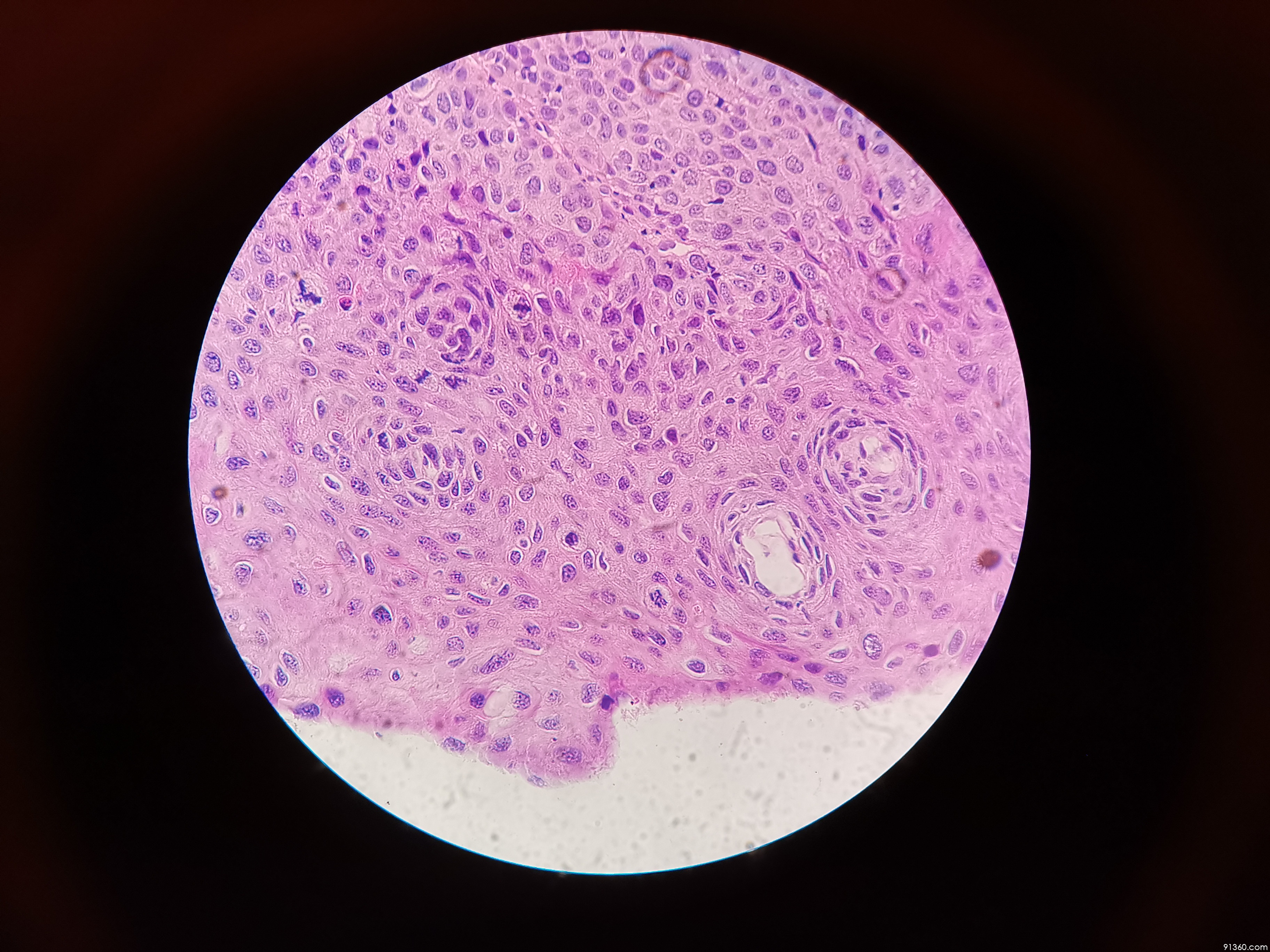 宫颈tct: hsil ,高级别【中美加宫颈病理交流群病例1401】
