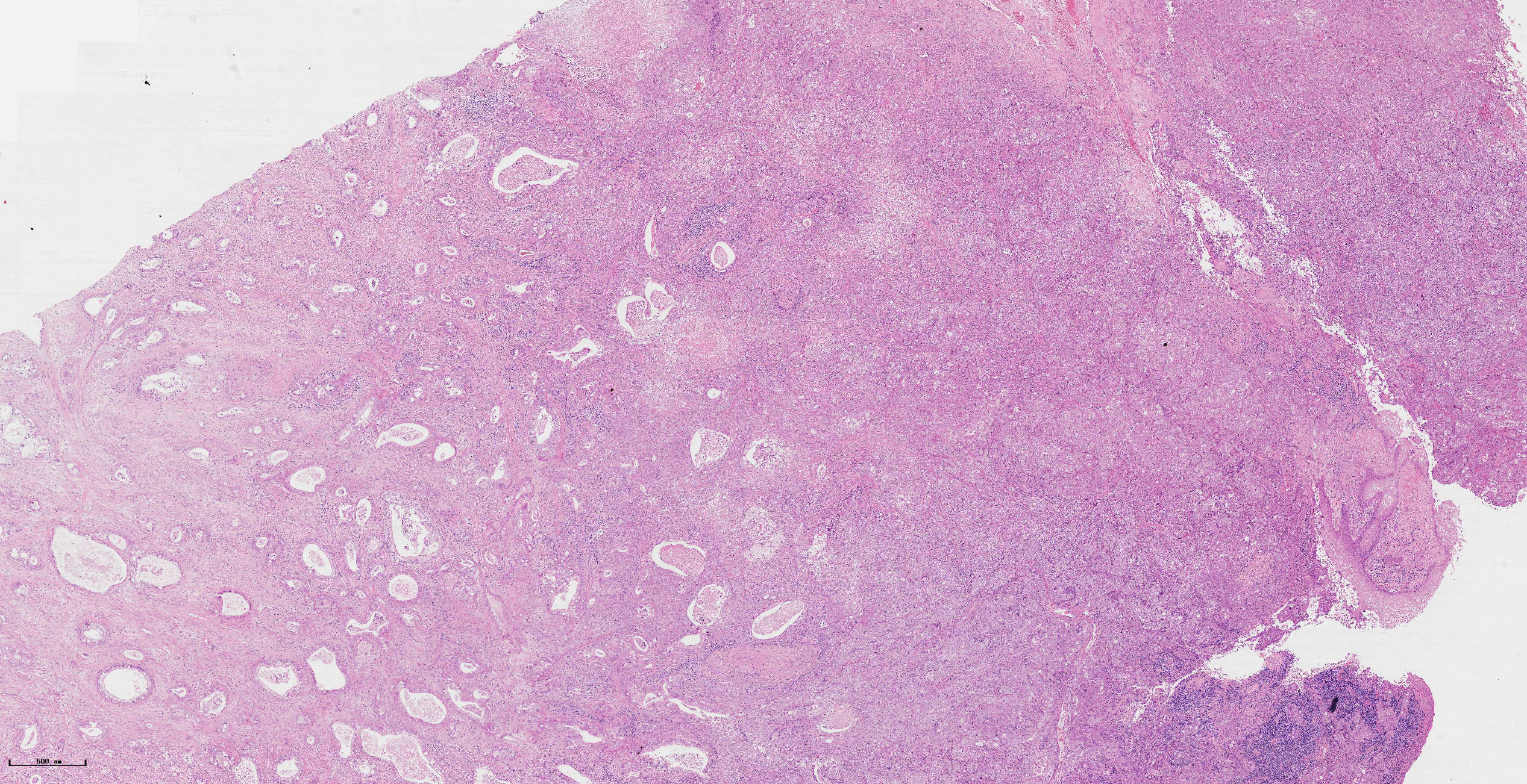 宫颈小细胞神经内分泌癌的临床特点及治疗策略 - 知乎